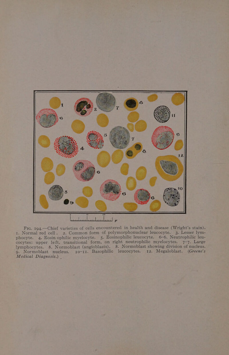 Fic. 194.—Chief varieties of cells encountered in health and disease (Wright’s stain). t. Normal red cell. 2. Common form of polymorphonuclear leucocyte. 3. Lesser lym- phocyte. 4. Eosin ophilic myelocyte. 5. Eosinophilic ‘leucocyte. 6-6. Neutrophilic leu- cocytes: upper left, transitional form, on right neutrophilic myelocytes. 7-7. Large lymphocytes. 8. Normoblast (angioblasts). 8. Normoblast showing division of nucleus. 9. Normoblast nucleus. 10-11. Basophilic leucocytes. 12. Megaloblast. (Greene's Medical Diagnosis.) .