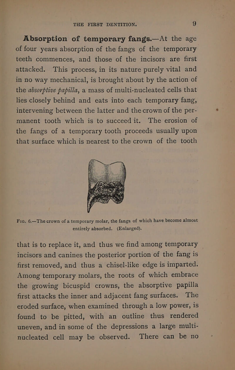 Absorption of temporary fangs.—At the age of four years absorption of the fangs of the temporary teeth commences, and those of the incisors are first attacked. This process, in its nature purely vital and in no way mechanical, is brought about by the action of the absorptive papilla, a mass of multi-nucleated cells that lies closely behind and eats into each temporary fang, intervening between the latter and the crown of the per- manent tooth which is to succeed it. The erosion of the fangs of a temporary tooth proceeds usually upon that surface which is nearest to the crown of the tooth Fic. 6,—The crown of a temporary molar, the fangs of which have become almost entirely absorbed. (Enlarged). that is to replace it, and thus we find among temporary incisors and canines the posterior portion of the fang is first removed, and thus a chisel-like edge is imparted. Among temporary molars, the roots of which embrace the growing bicuspid crowns, the absorptive papilla first attacks the inner and adjacent fang surfaces. The eroded surface, when examined through a low power, is found to be pitted, with an outline thus rendered uneven, and in some of the depressions a large multi- nucleated cell may be observed. There can be no