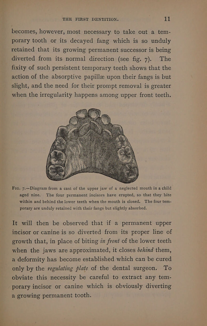 becomes, however, most necessary to take out a tem- porary tooth or its decayed fang which is so unduly retained that its growing permanent successor is being diverted from its normal direction (see fig: 7). /iThe fixity of such persistent temporary teeth shows that the action of the absorptive papille upon their fangs is but slight, and the need for their prompt removal is greater when the irregularity happens among upper front teeth. Fic. 7.—Diagram from a cast of the upper jaw of a neglected mouth in a child aged nine. The four permanent incisors have erupted, so that they bite within and behind the lower teeth when the mouth is closed. The four tem- porary are unduly retained with their fangs but slightly absorbed. It will then be observed that if a permanent upper incisor or canine is so diverted from its proper line of growth that, in place of biting 7m front of the lower teeth when the jaws are approximated, it closes behind them, a deformity has become established which can be cured only by the vegulating plate of the dental surgeon. To obviate this necessity be careful to extract any tem- porary incisor or canine which is obviously diverting a growing permanent tooth.