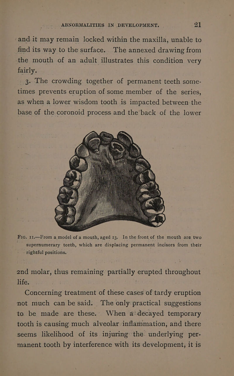 -and.it may remain locked within the maxilla, unable to find its way to the surface. The annexed drawing from -the mouth of an adult illustrates this condition very fairly. : | 3. The crowding together of permanent teeth some- times prevents eruption of some member of the series, as when a lower wisdom tooth is impacted between: the base of the coronoid process and the back of the lower Fic. 11.—From a model of a mouth, aged 13. In the front of the mouth are two ; supernumerary teeth, which are displacing permanent incisors from their rightful positions. and molar, thus remaining: partially erupted throughout life. Concerning treatment of these cases of tardy eruption not much can be said. ‘The only'practical suggestions to. be made are these. When a!decayed temporary tooth is causing much alveolar:inflammation, and there seems likelihood of its injuring the. underlying per- manent tooth by interference with its development, it is