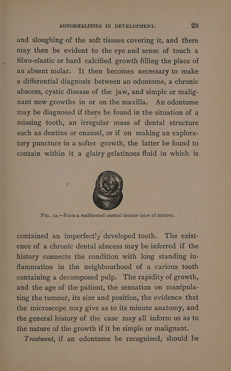 and sloughing of the soft tissues covering it, and there may then be evident to the eye and sense of touch a fibro-elastic or hard calcified growth filling the place of an absent molar. It then becomes necessary to make a differential diagnosis between an odontome, a chronic abscess, cystic disease of the jaw, and simple or malig- nant new growths in or on the maxilla. An odontome may be diagnosed if there be found in the situation of a missing tooth, an irregular mass of dental structure such as dentine or enamel, or if on making an explora- tory puncture in a softer growth, the latter be found to contain within it a glairy gelatinous fluid in which is Fic. 12.—From a malformed central incisor (size of nature). contained an imperfect}y developed tooth. The exist- ence of a chronic dental abscess may be inferred if the history connects the condition with long standing in- flammation in the neighbourhood of a carious tooth containing a decomposed pulp. The rapidity of growth, and the age of the patient, the sensation on manipula- ting the tumour, its size and position, the evidence that the microscope may give as to its minute anatomy, and the general history of the case may all inform us as to the nature of the growth if it be simple or malignant. Treatment, if-an odontome be recognised, should be