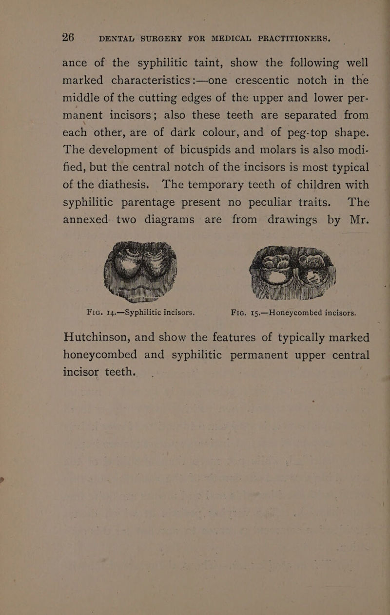 ance of the syphilitic taint, show the following well marked characteristics:—one crescentic notch in the middle of the cutting edges of the upper and lower per- manent incisors; also these teeth are separated from each other, are of dark colour, and of peg-top shape. The development of bicuspids and molars is also modi- fied, but the central notch of the incisors is most typical of the diathesis. ‘The temporary teeth of children with syphilitic parentage present no peculiar traits. The annexed: two diagrams are from drawings by Mr. AYE a iat © Sag Cura” Fic. 14.—Syphilitic incisors. Fic. 15.—Honeycombed incisors. Hutchinson, and show the features of typically marked honeycombed and syphilitic permanent upper central incisor teeth.