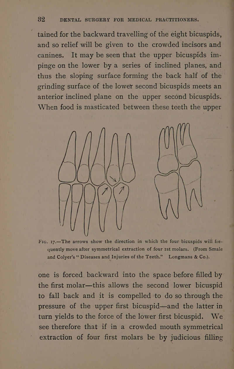 ~ tained for the backward travelling of the eight bicuspids, and so relief will be given to the crowded incisors and canines. It may be seen that the upper bicuspids im- pinge on the lower by a series of inclined planes, and thus the sloping surface forming the back half of the grinding surface of the lower second bicuspids meets an anterior inclined plane on the upper second bicuspids. When food is masticated between these teeth the upper Fic. 17.—The arrows show the direction in which the four bicuspids will fre- quently move after symmetrical extraction of four 1st molars. (From Smale and Colyer’s ‘‘ Diseases and Injuries of the Teeth.” Longmans &amp; Co.). one is forced backward into the space before filled by the first molar—this allows the second lower bicuspid to fall back and it is compelled to do so through the pressure of the upper first bicuspid—and the latter in turn yields to the force of the lower first bicuspid. We see therefore that if in a crowded mouth symmetrical extraction of four first molars be by judicious filling