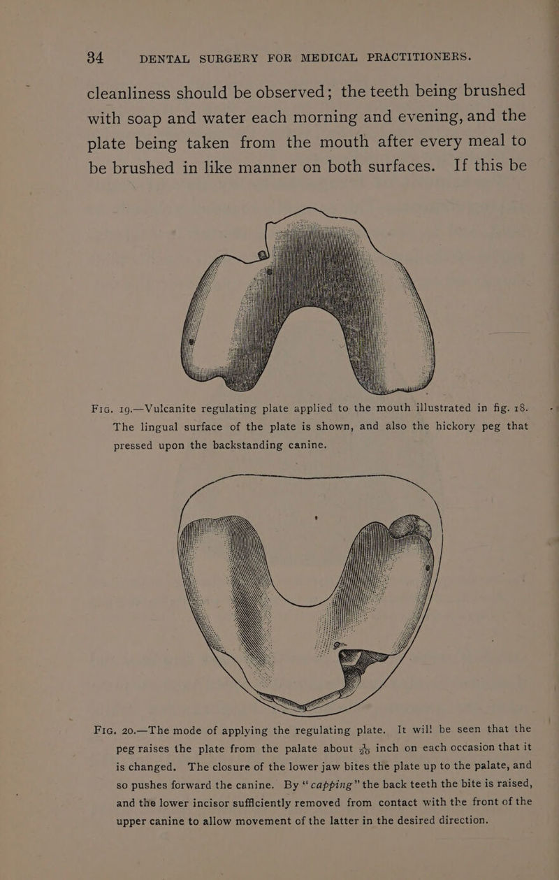 cleanliness should be observed; the teeth being brushed with soap and water each morning and evening, and the plate being taken from the mouth after every meal to be brushed in like manner on both surfaces. If this be Fic. 19.—Vulcanite regulating plate applied to the mouth illustrated in fig. 18. The lingual surface of the plate is shown, and also the hickory peg that pressed upon the backstanding canine. Fic. 20.—The mode of applying the regulating plate. It wil! be seen that the peg raises the plate from the palate about &lt;4 inch on each occasion that it is changed. The closure of the lower jaw bites the plate up to the palate, and so pushes forward the canine. By “capping” the back teeth the bite is raised, and the lower incisor sufficiently removed from contact with the front of the upper canine to allow movement of the latter in the desired direction.