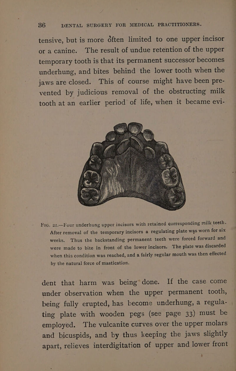 tensive, but is more often limited to one upper incisor or acanine. The result of undue retention of the upper temporary tooth is that its permanent successor becomes underhung, and bites behind the lower tooth when the jaws are closed. This of course might have been pre- vented by judicious removal of the obstructing milk tooth at an earlier period of life, when it became evi- Fic. 21.—Four underhung upper incisors with retained corresponding milk teeth. After removal of the temporary incisors a regulating plate was worn for six weeks. Thus the backstanding permanent teeth were forced forward and were made to bite in front of the lowerincisors. The plate was discarded when this condition was reached, and a fairly regular mouth was then effected by the natural force of mastication. dent that harm was being’ done. If the case come under observation when the upper permanent tooth, being fully erupted, has become underhung, a regula- ting plate with wooden pegs (see page 33) must be employed. The vulcanite curves over the upper molars and bicuspids, and by thus keeping the jaws slightly apart, relieves interdigitation of upper and lower front