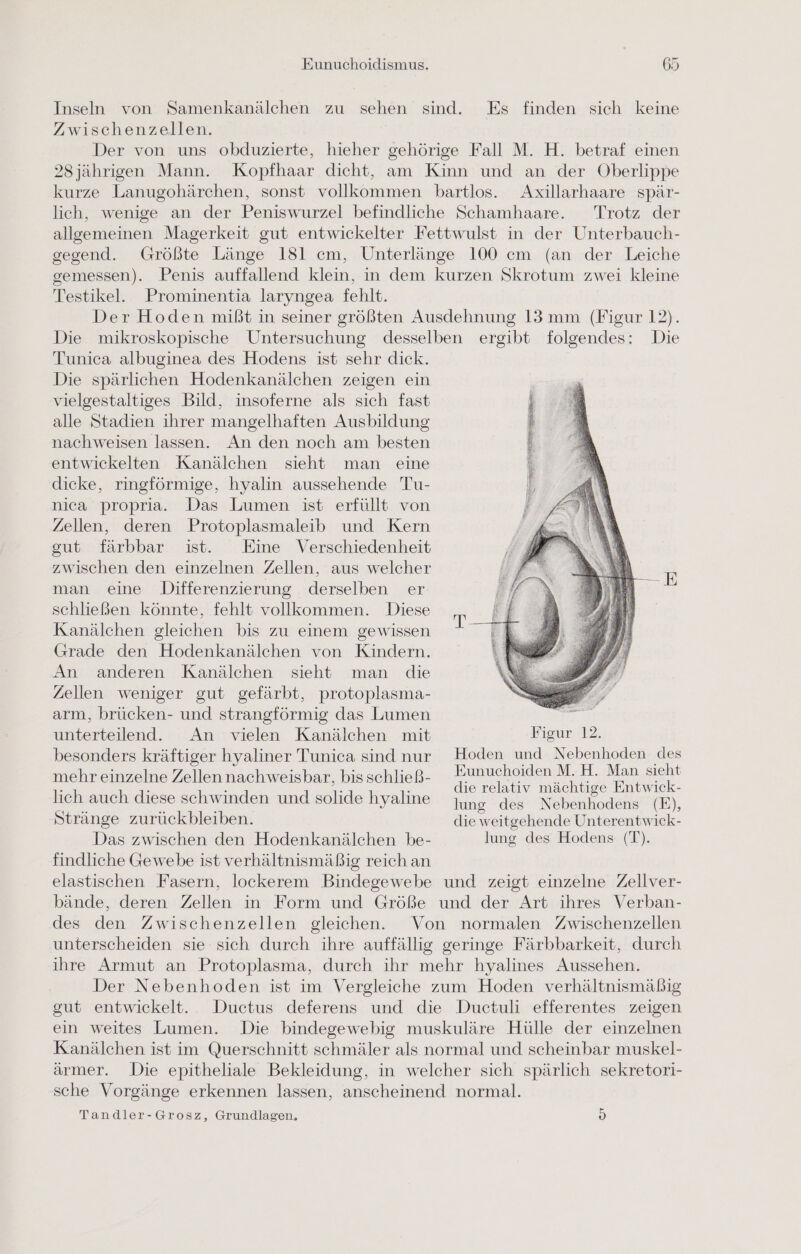 Inseln von Samenkanälchen zu sehen sind. Es finden sich keine Zwischenzellen. Der von uns obduzierte, hieher gehörige Fall M. H. betraf einen 2Sjährigen Mann. Kopfhaar dicht, am Kinn und an der Oberlippe kurze Lanugohärchen, sonst vollkommen bartlos. Axillarhaare spär- lich, wenige an der Peniswurzel befindliche Schamhaare. Trotz der allgemeinen Magerkeit gut entwickelter Fettwulst in der Unterbauch- gegend. Größte Länge 181 cm, Unterlänge 100 cm (an der Leiche gemessen). Penis auffallend klein, in dem kurzen Skrotum zwei kleine Testikel. Prominentia laryngea fehlt. Der Hoden mißt in seiner größten Ausdehnung 13 mm (Figur 12). Die mikroskopische Untersuchung desselben ergibt folgendes: Die Tunica albuginea des Hodens ist sehr dick. Die spärlichen Hodenkanälchen zeigen ein vielgestaltiges Bild, insoferne als sich fast alle Stadien ihrer mangelhaften Ausbildung nachweisen lassen. An den noch am besten entwickelten Kanälchen sieht man eine dicke, ringförmige, hyalin aussehende Tu- nica propria. Das Lumen ist erfüllt von Zellen, deren Protoplasmaleib und Kern gut färbbar ist. Eine Verschiedenheit zwischen den einzelnen Zellen, aus welcher man eine Differenzierung derselben er schließen könnte, fehlt vollkommen. Diese Kanälchen gleichen bis zu einem gewissen Grade den Hodenkanälchen von Kindern. An anderen Kanälchen sieht man die Zellen weniger gut gefärbt, protoplasma- arm, brücken- und strangförmig das Lumen unterteilend.. An vielen Kanälchen mit Figur 12, besonders kräftiger hyaliner Tunica sindnur Hoden und Nebenhoden des mehr einzelne Zellennachweisbar, bisschließ- Hunuchoiden M. H. Man RN lich auch diese schwinden und solide hyaline 5 n a a Ä h s ung des Nebenhodens (E), Stränge zurückbleiben. die weitgehende Unterentwick- Das zwischen den Hodenkanälchen be- lung des Hodens (T). findliche Gewebe ist verhältnismäßig reich an elastischen Fasern, lockerem Bindegewebe und zeigt einzelne Zellver- bände, deren Zellen in Form und Größe und der Art ihres Verban- des den Zwischenzellen gleichen. Von normalen Zwischenzellen unterscheiden sie sich durch ihre auffällig geringe Färbbarkeit, durch ihre Armut an Protoplasma, durch ihr mehr hyalines Aussehen. Der Nebenhoden ist im Vergleiche zum Hoden verhältnismäßig gut entwickelt. Ductus deferens und die Ductuli efferentes zeigen ein weites Lumen. Die bindegewebig muskuläre Hülle der einzelnen Kanälchen ist im Querschnitt schmäler als normal und scheinbar muskel- ärmer. Die epitheliale Bekleidung, in welcher sich spärlich sekretori- sche Vorgänge erkennen lassen, anscheinend normal. Tandler-Grosz, Grundlagen. B)