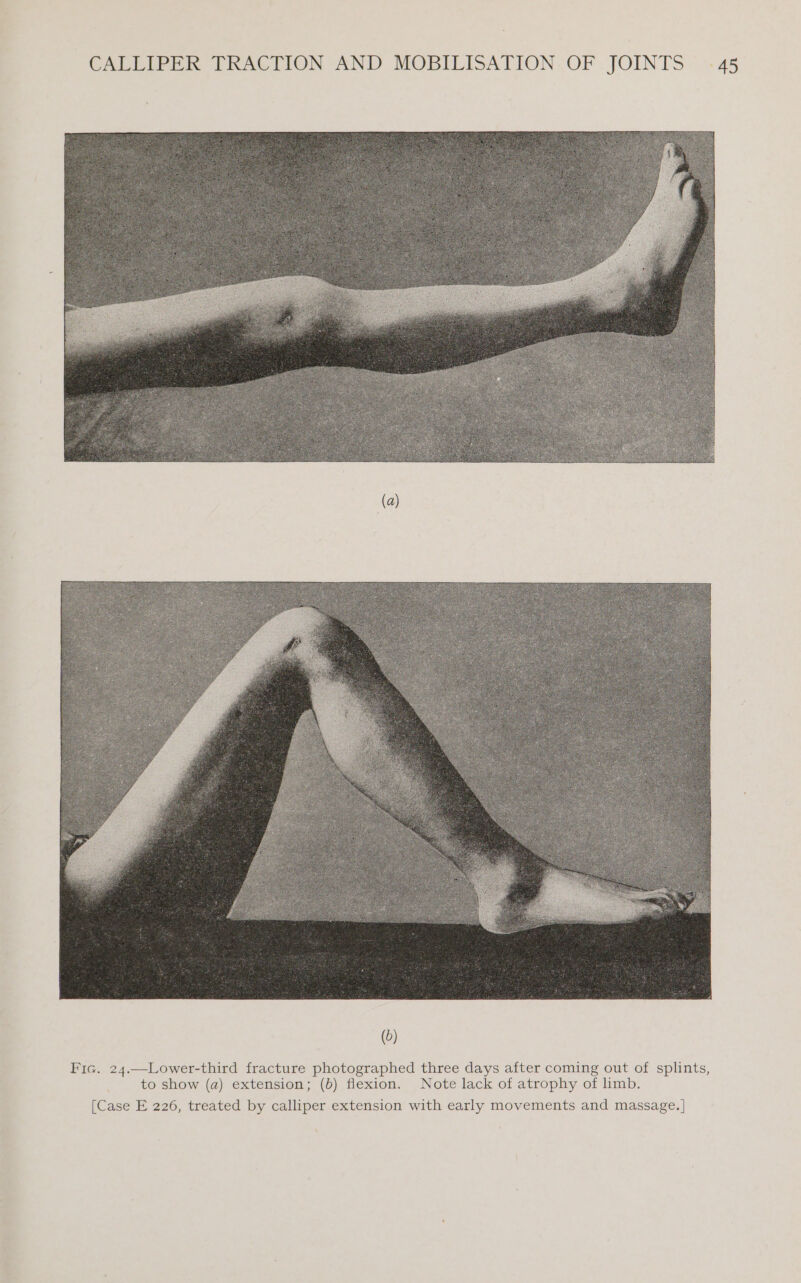 Fic. 24.—-Lower-third fracture photographed three days after coming out of splints, to show (a) extension; (b) flexion. Note lack of atrophy of limb. [Case E 226, treated by calliper extension with early movements and massage. |