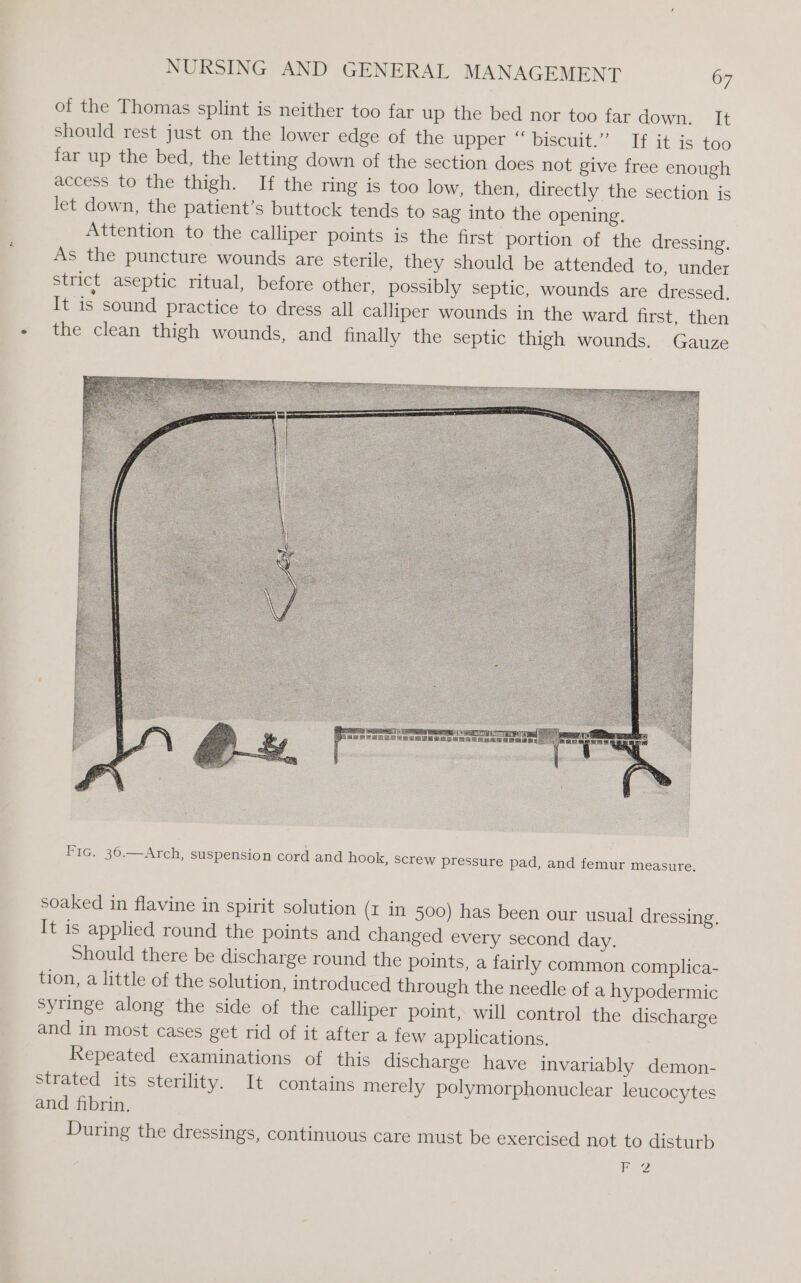 of the Thomas splint is neither too far up the bed nor too far down. It should rest just on the lower edge of the upper “ biscuit.” If it is too far up the bed, the letting down of the section does not give free enough access to the thigh. If the ring is too low, then, directly the section is let down, the patient’s buttock tends to sag into the opening. Attention to the calliper points is the first portion of the dressing. As the puncture wounds are sterile, they should be attended to, under strict aseptic ritual, before other, possibly septic, wounds are dressed. It is sound practice to dress all calliper wounds in the ward first, then the clean thigh wounds, and finally the septic thigh wounds. Gauze Fic. 36.—Arch, suspension cord and hook, screw pressure pad, and femur measure. soaked in flavine in spirit solution (I in 500) has been our usual dressing. It is applied round the points and changed every second day. Should there be discharge round the points, a fairly common complica- tion, a little of the solution, introduced through the needle of a hypodermic syringe along the side of the calliper point, will control the discharge and in most cases get rid of it after a few applications. Repeated examinations of this discharge have invariably demon- strated its sterility. It contains merely polymorphonuclear leucocytes and fibrin. During the dressings, continuous care must be exercised not to disturb F 2