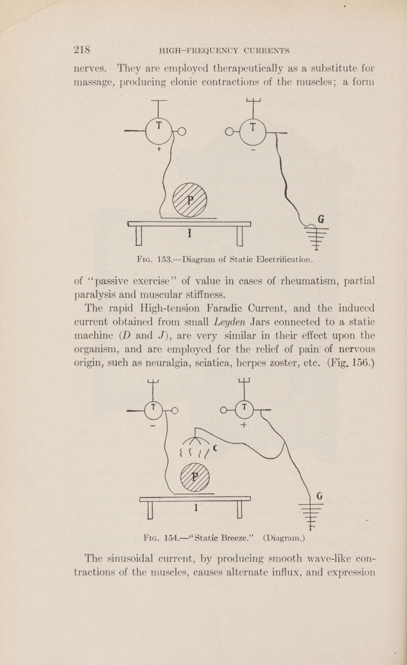 nerves. They are employed therapeutically as a substitute for massage, producing clonic contractions of the muscles; a form of ‘‘passive exercise”? of value in cases of rheumatism, partial paralysis and muscular stiffness. The rapid High-tension Faradic Current, and the induced current obtained from small Leyden Jars connected to a static machine (D and J), are very similar in their effect upon the organism, and are employed for the relief of pain’ of nervous origin, such as neuralgia, sciatica, herpes zoster, etc. (Fig, 156.) cee Y naa ie Fic. 154.—“Statie Breeze.” (Diagram.) The sinusoidal current, by producing smooth wave-like con- tractions of the muscles, causes alternate influx, and expression.