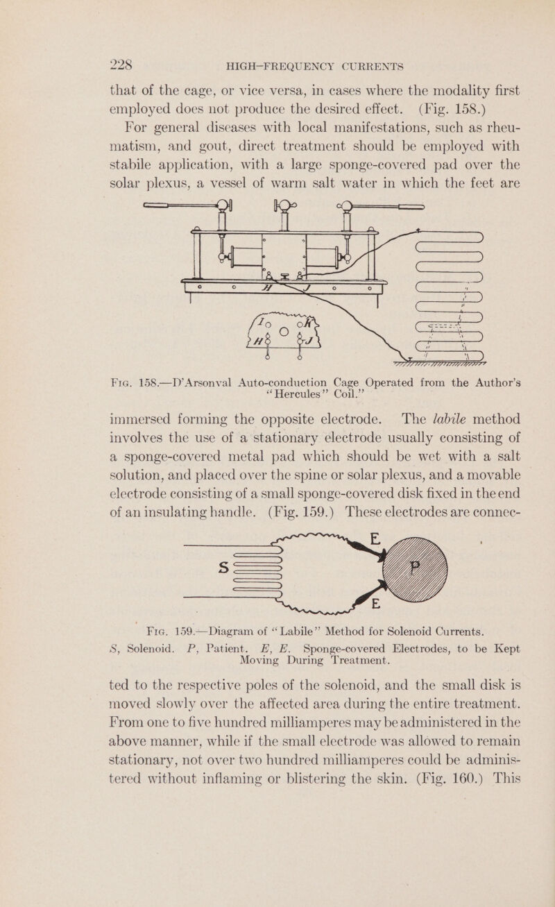 Fig. 158.—D’Arsonval Auto-conduction Cage Operated from the Author’s “Hercules”? Coil.” immersed forming the opposite electrode. The /abile method involves the use of a stationary electrode usually consisting of a sponge-covered metal pad which should be wet with a salt solution, and placed over the spine or solar plexus, and a movable electrode consisting of a small sponge-covered disk fixed in the end of an insulating handle. (Fig. 159.) These electrodes are connec- ‘Fra. 159.—Diagram of “Labile’’ Method for Solenoid Currents. S, Solenoid. P, Patient. H, E. Sponge-covered Electrodes, to be Kept Moving During Treatment. ted to the respective poles of the solenoid, and the small disk is moved slowly over the affected area during the entire treatment. From one to five hundred milliamperes may be administered in the above manner, while if the small electrode was allowed to remain stationary, not over two hundred milliamperes could be adminis- tered without inflaming or blistering the skin. (Fig. 160.) This