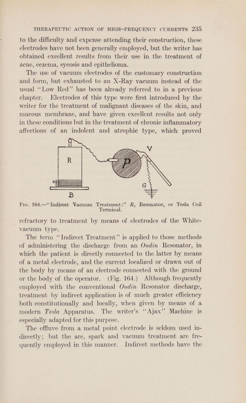 to the difficulty and expense attending their construction, these electrodes have not been generally employed, but the writer has obtained excellent results from their use in the treatment of acne, eczema, sycosis and epithelioma. The use of vacuum electrodes of the customary construction and form, but exhausted to an X-Ray vacuum instead of the usual “‘Low Red” has been already referred to in a previous chapter. Electrodes of this type were first introduced by the writer for the treatment of malignant diseases of the skin, and mucous membrane, and have given excellent results not only in these conditions but in the treatment of chronic inflammatory affections of an indolent and atrophic type, which proved Fia. 164.—“ Indirect Vacuum Treatment:’” &amp;, Resonator, or Tesla Coil Terminal. _ refractory to treatment by means of electrodes of the White- vacuum type. The term ‘‘Indirect Treatment” is applied to those methods of administering the discharge from an Oudin Resonator, in which the patient is directly connected to the latter by means of a metal electrode, and the current localized or drawn out of the body by means of an electrode connected with the ground or the body of the operator. (Fig. 164.) Although frequently employed with the conventional Oudin Resonator discharge, treatment by indirect application is of much greater efficiency both constitutionally and locally, when given by means of a modern Tesla Apparatus. The writer’s ‘‘Ajax’’ Machine is especially adapted for this purpose. The effluve from a metal point electrode is seldom used in- directly; but the are, spark and vacuum treatment are fre- quently employed in this manner. Indirect methods have the