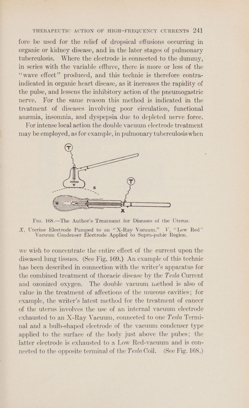 fore be used for the relief of dropsical effusions occurring in organic or kidney disease, and in the later stages of pulmonary tuberculosis. Where the electrode is connected to the dummy, : in series with the variable effluve, there is more or less of the “wave effect’? produced, and this technic is therefore contra- indicated in organic heart disease, as it increases the rapidity of the pulse, and lessens the inhibitory action of the pneumogastric nerve. For the same reason this method is indicated in the treatment of diseases involving poor circulation, functional anzmia, insomnia, and dyspepsia due to depleted nerve force. For intense local action the double vacuum electrode treatment may be employed, as for example, in pulmonary tuberculosis when Fic. 168.—The Author’s Treatment for Diseases of the Uterus. X, Uterine Electrode Pumped to an “X-Ray Vacuum.” V, “Low Red” Vacuum Condenser Electrode Applied to Supra-pubic Region. we wish to concentrate the entire effect of the current upon the diseased lung tissues. (See Fig. 169.) An example of this technic has been described in connection with the writer’s apparatus for the combined treatment of thoracic disease by the Tesla Current and ozonized oxygen. The double vacuum method is also of value in the treatment of affections of the mucous cavities; for example, the writer’s latest method for the treatment of cancer of the uterus involves the use of an internal vacuum electrode exhausted to an X-Ray Vacuum, connected to one Tesla Termi- nal and a bulb-shaped electrode of the vacuum condenser type applied to the surface of the body Just above the pubes; the latter electrode is exhausted to a Low Red-vacuum and is con- nected to the opposite terminal of the Tesla Coil. (See Fig. 168.)