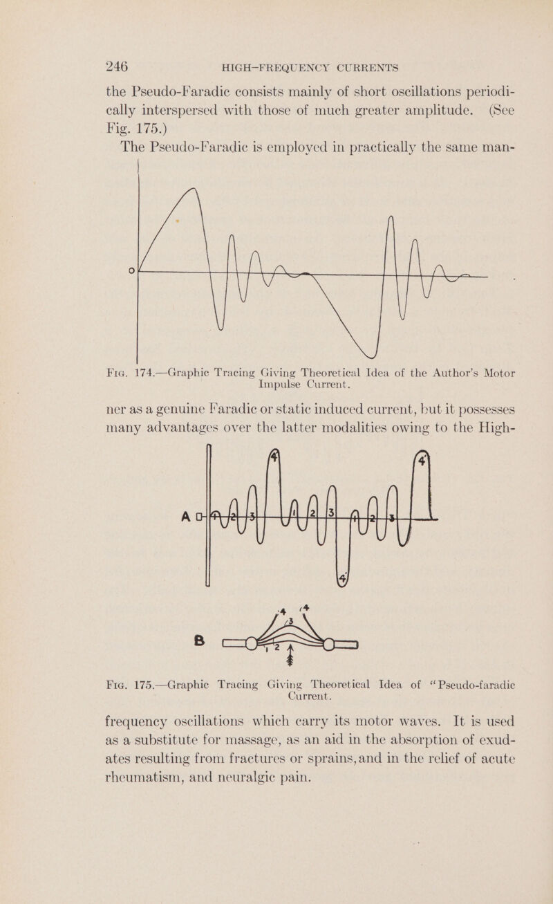 the Pseudo-Faradic consists mainly of short oscillations periodi- cally interspersed with those of much greater amplitude. (See Hig. 175.) The Pseudo-Faradic is employed in practically the same man- Fie. 174.—Graphic Tracing Giving Theoretical Idea of the Author’s Motor Impulse Current. ner as a genuine [*aradic or static induced current, but it possesses many advantages over the latter modalities owing to the High- “4 Fig. 175.—Graphic Tracing Giving Theoretical Idea of ‘“ Pseudo-faradic Current. frequency oscillations which carry its motor waves. It is used as a substitute for massage, as an aid in the absorption of exud- ates resulting from fractures or sprains,and in the relief of acute rheumatism, and neuralgic pain.