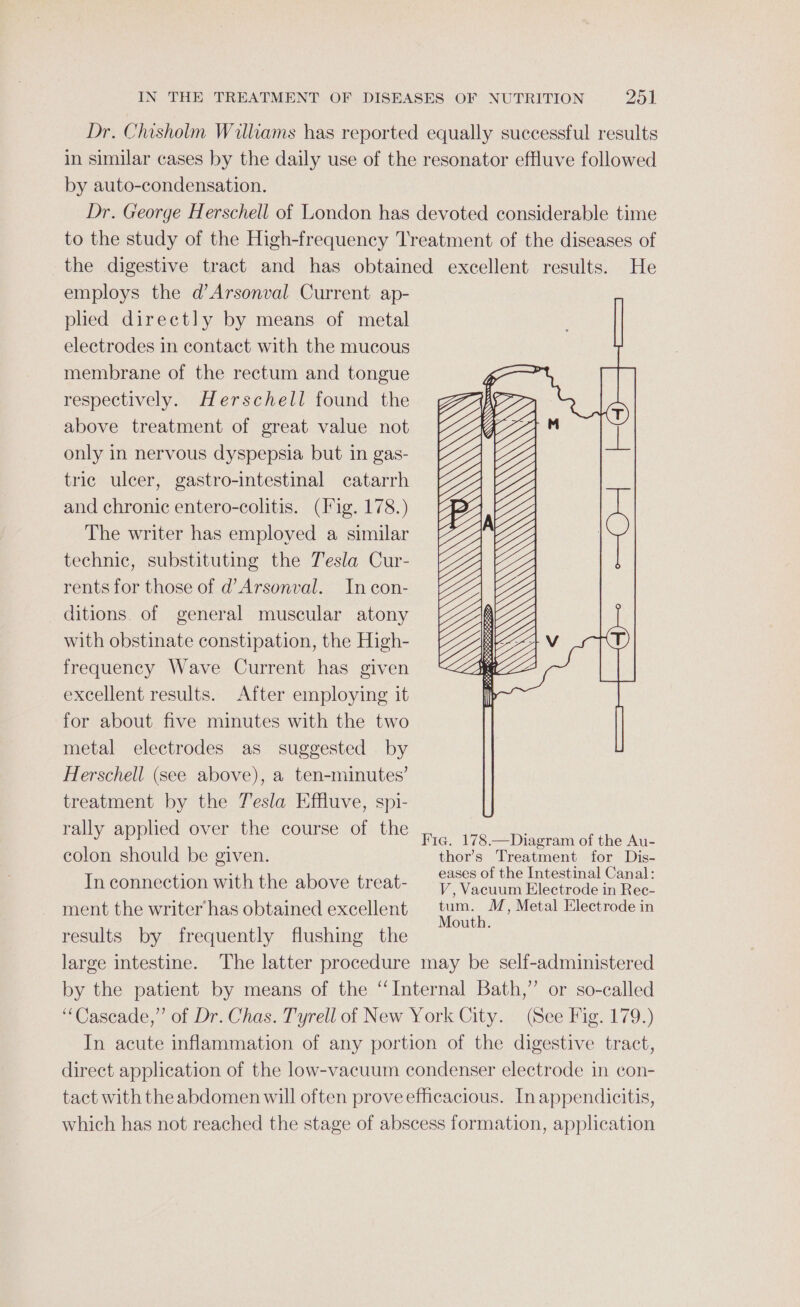 Dr. Chisholm Williams has reported equally successful results in similar cases by the daily use of the resonator effluve followed by auto-condensation. Dr. George Herschell of London has devoted considerable time to the study of the High-frequency Treatment of the diseases of the digestive tract and has obtained excellent results. He employs the d’Arsonval Current ap- pled directly by means of metal electrodes in contact with the mucous membrane of the rectum and tongue respectively. Herschell found the above treatment of great value not only in nervous dyspepsia but in gas- tric ulcer, gastro-intestinal catarrh and chronic entero-colitis. (ig. 178.) The writer has employed a similar technic, substituting the Tesla Cur- rents for those of d’Arsonval. In con- ditions. of general muscular atony with obstinate constipation, the High- frequency Wave Current has given excellent results. After employing it for about five minutes with the two metal electrodes as suggested by Herschell (see above), a ten-minutes’ treatment by the 7'esla Effluve, spi- rally applied over the course of the fi Wye pispraorthe wh colon should be given. thor’s Treatment for Dis- In connection with the above treat- ee ee ae ment the writer has obtained excellent fee » Metal Electrode in results by frequently flushing the large intestine. The latter procedure may be self-administered by the patient by means of the “Internal Bath,” or so-called “Cascade,” of Dr. Chas. Tyrell of New York City. (See Fig. 179.) In acute inflammation of any portion of the digestive tract, direct application of the low-vacuum condenser electrode in con- tact with the abdomen will often prove efficacious. In appendicitis, which has not reached the stage of abscess formation, application