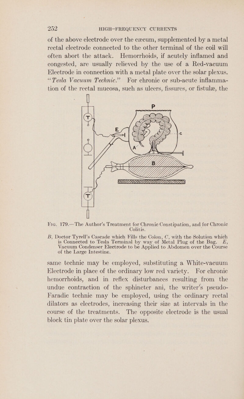 of the above electrode over the czecum, supplemented by a metal rectal electrode connected to the other terminal of the coil will often abort the attack. Hemorrhoids, if acutely inflamed and congested, are usually relieved by the use of a Red-vacuum Electrode in connection with a metal plate over the solar plexus. “Tesla Vacuum Technic.” For chronic or sub-acute inflamma- tion of the rectal mucosa, such as ulcers, fissures, or fistula, the Eig. 179.—The Author’s Treatment for Chronic Constipation, and for Chronic Colitis. B, Doctor Tyrell’s Cascade which Fills the Colon, C, with the Solution which is Connected to Tesla Terminal by way of Metal Plug of the Bag. £, Vacuum Condenser Electrode to be Applied to Abdomen over the Course of the Large Intestine. same technic may be employed, substituting a White-vacuum Electrode in place of the ordinary low red variety. For chronic hemorrhoids, and in reflex disturbances resulting from the undue contraction of the sphincter ani, the writer’s pseudo- Faradic technic may be employed, using the ordinary rectal dilators as electrodes, increasing their size at intervals in the course of the treatments. The opposite electrode is the usual block tin plate over the solar plexus.