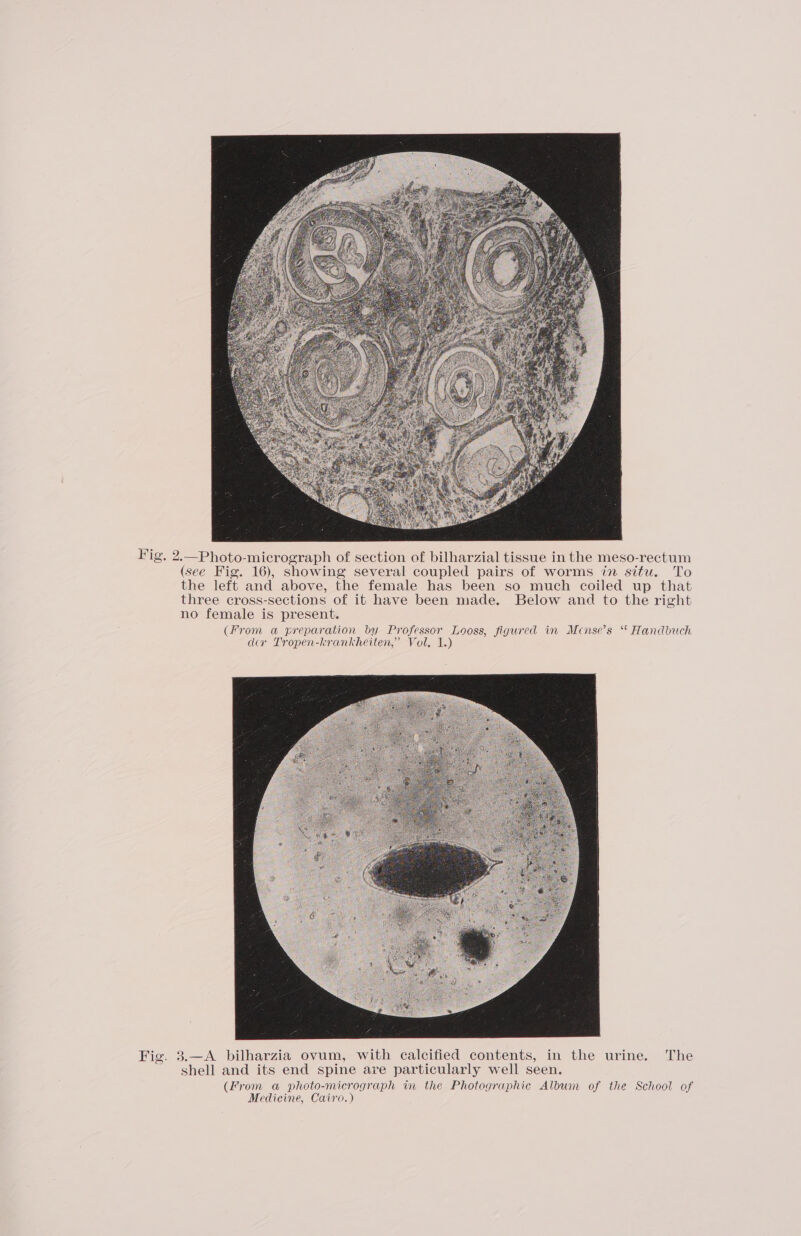 Fig. 2.—Photo-micrograph of section of bilharzial tissue in the meso-rectum (see Fig. 16), showing several coupled pairs of worms in situ. To the left and above, the female has been so much coiled up that three cross-sections of it have been made. Below and to the right no female is present. (From a preparation by Professor Looss, figured in Mcnse’s “ Handbuch dav Tropen-krankheiten,’ Vol, 1.) Fig. 3.—A bilharzia ovum, with calcified contents, in the urine. The shell and its end spine are particularly well seen. (From a photo-micrograph in the Photographic Album of the School of Medicine, Cairo.)