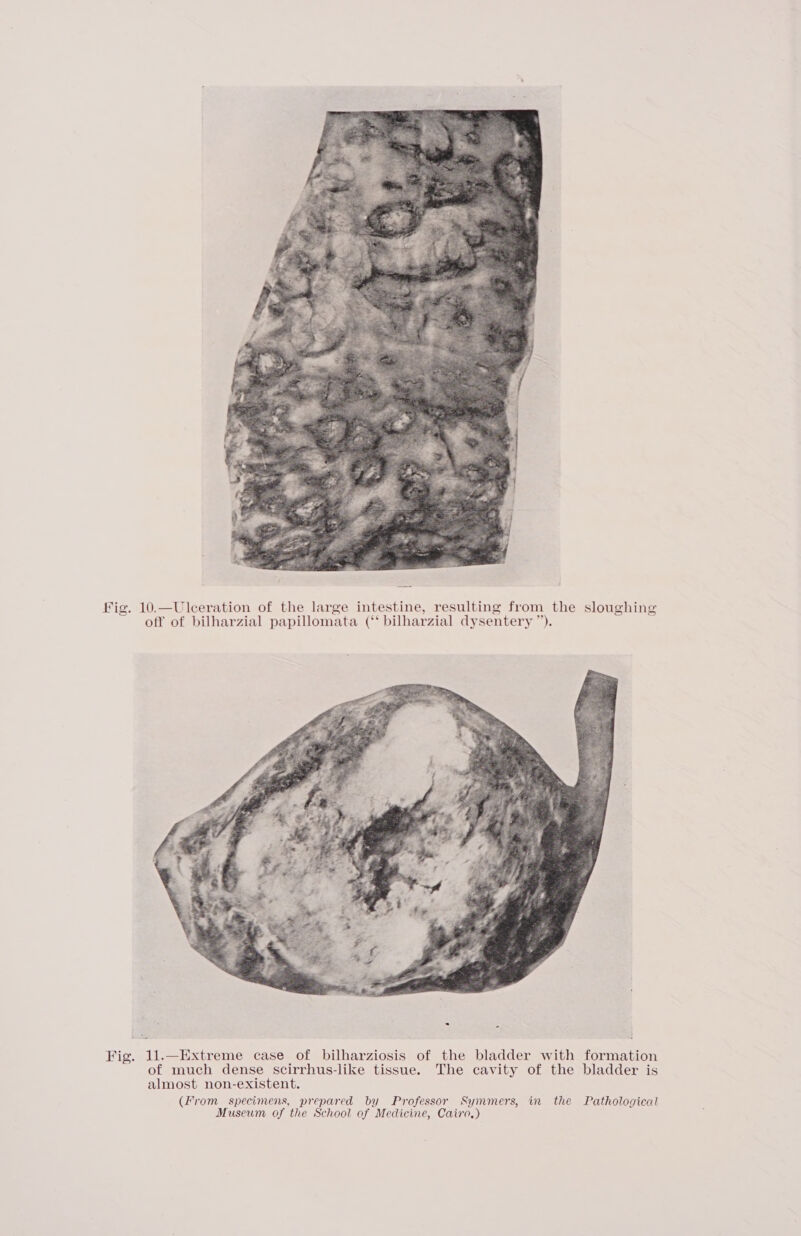 fig. 10.—Uleceration of the large intestine, resulting from the sloughing off of bilharzial papillomata (‘‘ bilharzial dysentery ”’). Fig. 11.—Extreme case of bilharziosis of the bladder with formation of much dense scirrhus-like tissue. The cavity of the bladder is almost non-existent. (From specimens, prepared by Professor Symmers, in the Pathological Museum of the School of Medicine, Cairo.)