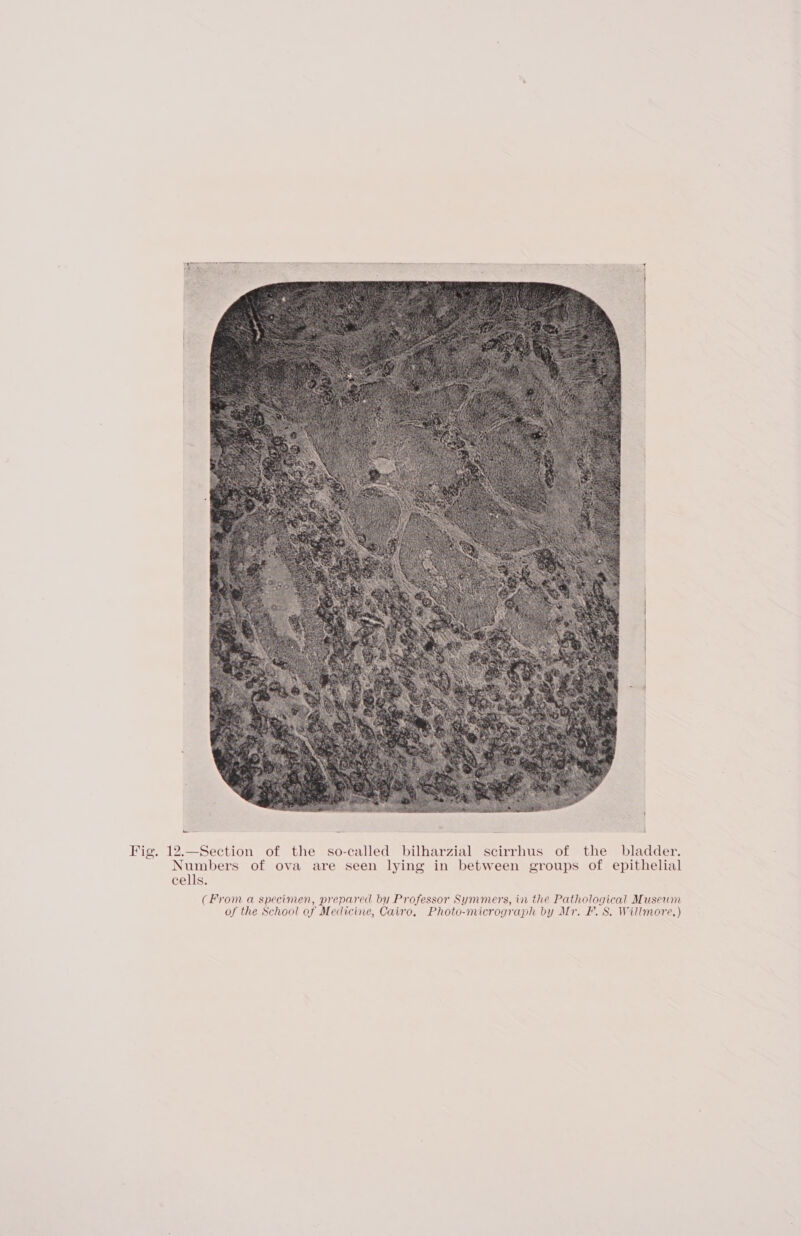 IF eae Samet pauehee Sameaeeenaae Beak. testa aca, a - oa d Fig. 12.—Section of the so-called bilharzial scirrhus of the bladder. Numbers of ova are seen lying in between groups of epithelial cells. (From a specimen, prepared by Professor Symmers, in the Pathological Museum of the School of Medicine, Cairo. Photo-micrograph by Mr. F. 8S. Willmore.)