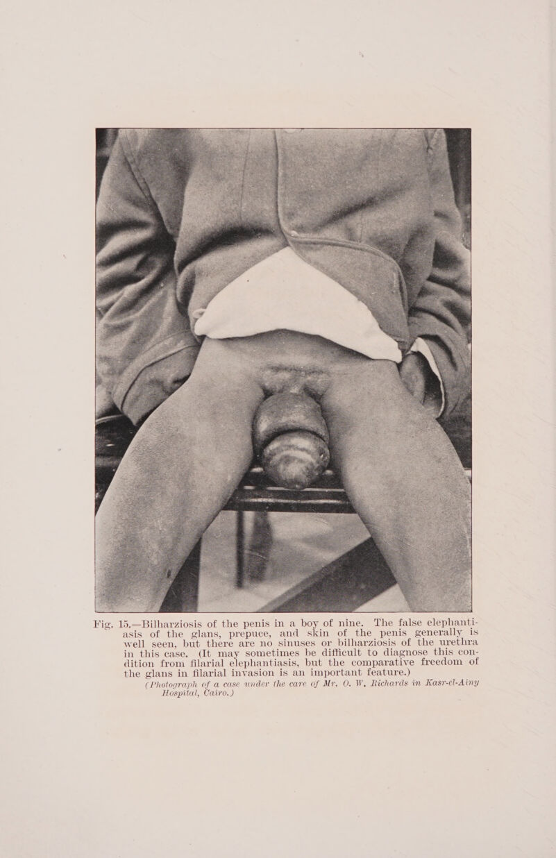 5.—Bilharziosis of the penis in a boy of nine. The false elephanti- asis of the glans, prepuce, and skin of the penis generally is well seen, but there are no sinuses or bilharziosis of the urethra in this case. (It may sometimes be difficult to diagnose this con- dition from filarial elephantiasis, but the comparative freedom of the glans in filarial invasion is an important feature.) (Photograph of a case under the care of Mr. O. W, Richards in Kasr-cl-Ainy Hospital, Cairo.)