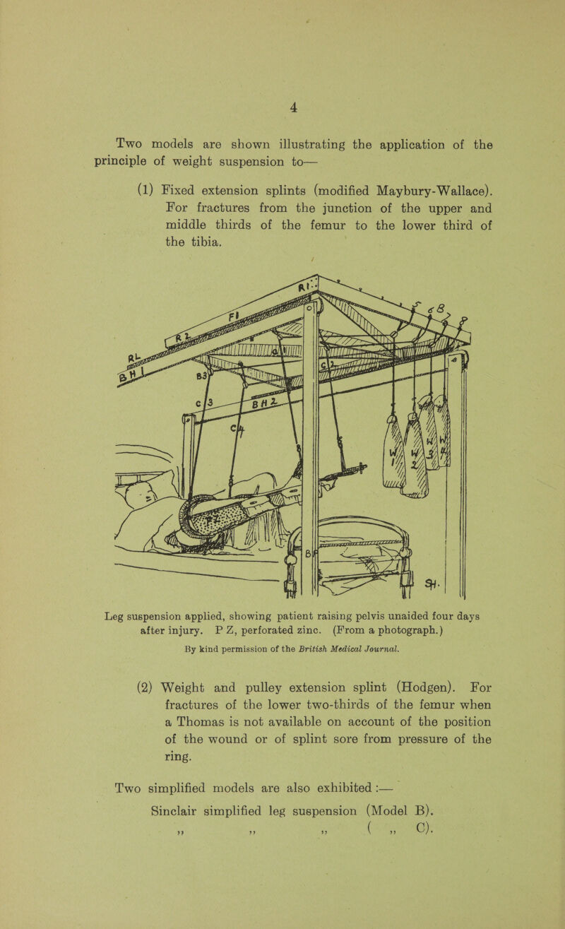 Two models are shown illustrating the application of the principle of weight suspension to— Ms =a ba dg fie z SS: CSS Ss SSS Leg suspension applied, showing patient raising pelvis unaided four days after injury. PZ, perforated zinc. (From a photograph.) By kind permission of the British Medical Journal. (2) Weight and pulley extension splint (Hodgen). For fractures of the lower two-thirds of the femur when a Thomas is not available on account of the position of the wound or of splint sore from pressure of the ring. Two simplified models are also exhibited :— Sinclair simplified leg suspension (Model B). rr) ” 9 ( 9 Gy: