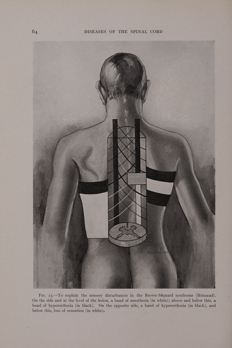 Fic. 23.—To explain the sensory disturbances in the Brown-Séquard syndrome (Brissaud). On the side and at the level of the lesion, a band of anesthesia (in white); above and below this, a band of hyperesthesia (in black). On the opposite side, a band of hyperesthesia (in black), and below this, loss of sensation (in white).