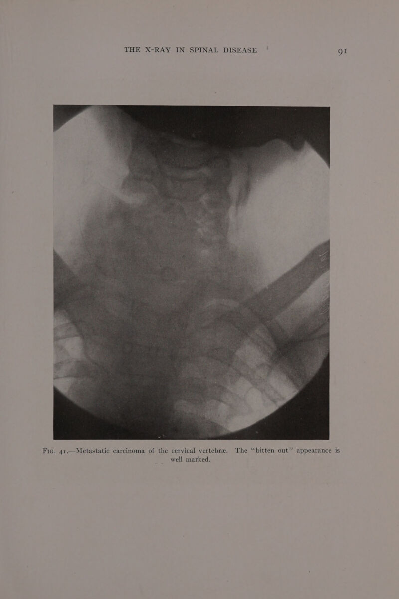 Fic. 41.—Metastatic carcinoma of the cervical vertebre. well marked. appearance gr is