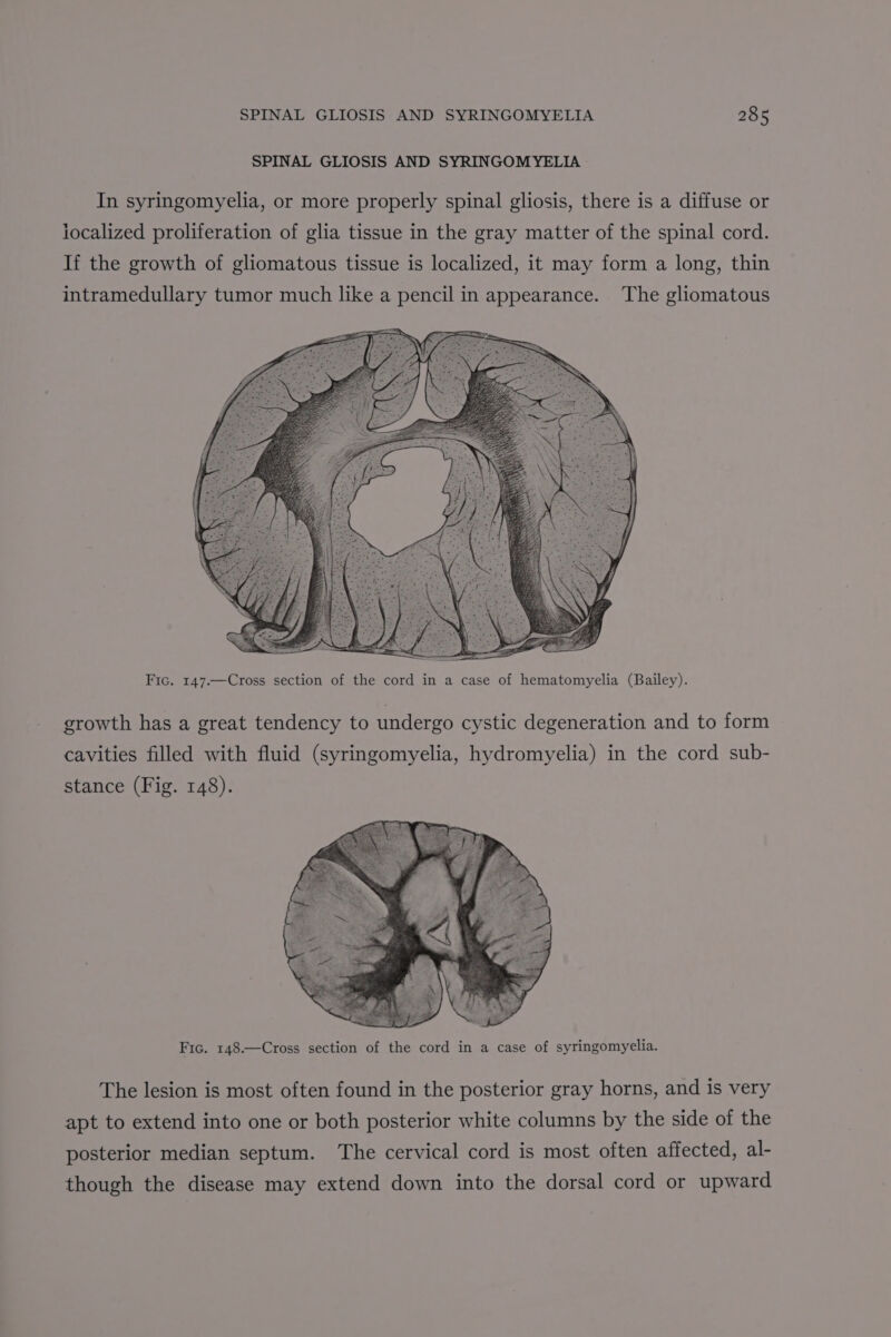 SPINAL GLIOSIS AND SYRINGOMYELIA In syringomyelia, or more properly spinal gliosis, there is a diffuse or localized proliferation of glia tissue in the gray matter of the spinal cord. If the growth of gliomatous tissue is localized, it may form a long, thin intramedullary tumor much like a pencil in appearance. The gliomatous Fic. 147.—Cross section of the cord in a case of hematomyelia (Bailey). growth has a great tendency to undergo cystic degeneration and to form cavities filled with fluid (syringomyelia, hydromyelia) in the cord sub- stance (Fig. 148). Fic. 148.—Cross section of the cord in a case of syringomyelia. The lesion is most often found in the posterior gray horns, and is very apt to extend into one or both posterior white columns by the side of the posterior median septum. The cervical cord is most often affected, al- though the disease may extend down into the dorsal cord or upward