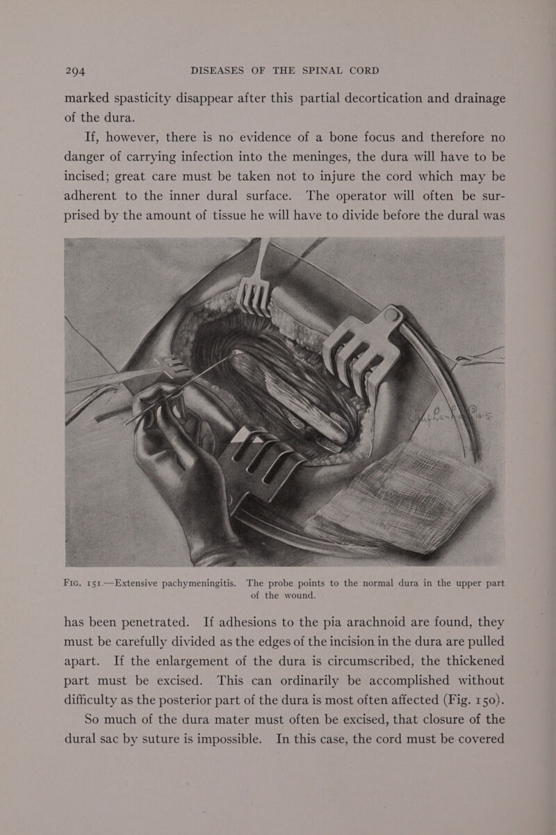 marked spasticity disappear after this partial decortication and drainage of the dura. If, however, there is no evidence of a bone focus and therefore no danger of carrying infection into the meninges, the dura will have to be incised; great care must be taken not to injure the cord which may be adherent to the inner dural surface. The operator will often be sur- prised by the amount of tissue he will have to divide before the dural was Fic. 151.—Extensive pachymeningitis. The probe points to the normal dura in the upper part of the wound. has been penetrated. If adhesions to the pia arachnoid are found, they must be carefully divided as the edges of the incision in the dura are pulled apart. If the enlargement of the dura is circumscribed, the thickened part must be excised. This can ordinarily be accomplished without difficulty as the posterior part of the dura is most often affected (Fig. 150). So much of the dura mater must often be excised, that closure of the dural sac by suture is impossible. In this case, the cord must be covered