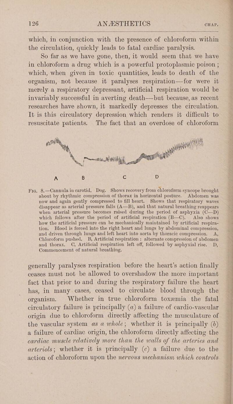 which, in conjunction with the presence of chloroform within the circulation, quickly leads to fatal cardiac paralysis. So far as we have gone, then, it would seem that we have in chloroform a drug which is a powerful protoplasmic poison ; which, when given in toxic quantities, leads to death of the organism, not because it paralyses respiration—for were it merely a respiratory depressant, artificial respiration would be invariably successful in averting death—but because, as recent researches have shown, it markedly depresses the circulation. It is this circulatory depression which renders it difficult to resuscitate patients. The fact that an overdose of chloroform m um hy sen A Ni Nh ih ! \, ih ae iy : | Arg plight Nn eos of i | 4, tl od w i A B Cc D Fic. 8.—Cannula in carotid. Dog. Shows recovery from chloroform syncope brought about by rhythmic compression of thorax in horizontal posture. Abdomen was now and again gently compressed to fill heart. Shows that respiratory waves disappear as arterial pressure falls (A—B), and that natural breathing reappears when arterial pressure becomes raised during the period of asphyxia (C—D) which follows after the period of artificial respiration (B—C). Also shows how the artificial pressure can be mechanically maintained by artificial respira- tion. Blood is forced into the right heart and lungs by abdominal compression, and driven through lungs and left heart into aorta by thoracic compression. A, Chloroform pushed. B, Artificial respiration : alternate compression of abdomen and thorax. OC, Artificial respiration left off, followed by asphyxial rise. D, Commencement of natural breathing. generally paralyses respiration before the heart’s action finally ceases must not be allowed to overshadow the more important fact that prior to and during the respiratory failure the heart has, in many cases, ceased to circulate blood through the organism. Whether in true chloroform toxemia the fatal circulatory failure is principally (a) a failure of cardio-vascular origin due to chloroform directly affecting the musculature of the vascular system as a whole; whether it is principally (0) a failure of cardiac origin, the chloroform directly affecting the cardiac muscle relatively more than the walls of the arteries and arteriols; whether it is principally (c) a failure due to the action of chloroform upon the nervous mechanism which controls