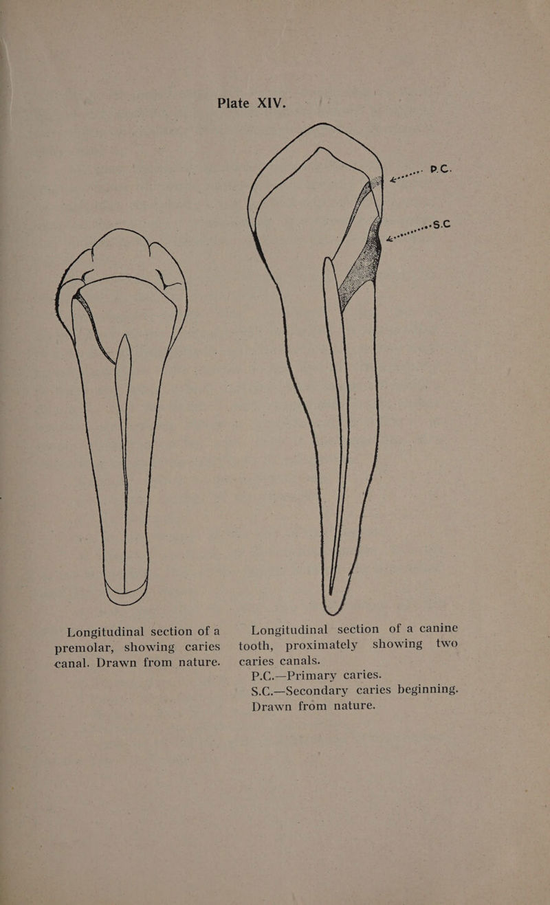 Plate XIV. Longitudinal section of a Longitudinal section of a canine premolar, showing caries tooth, proximately showing two canal. Drawn from nature. caries canals. P.C.—Primary caries. S.C.—Secondary caries beginning. Drawn from nature.