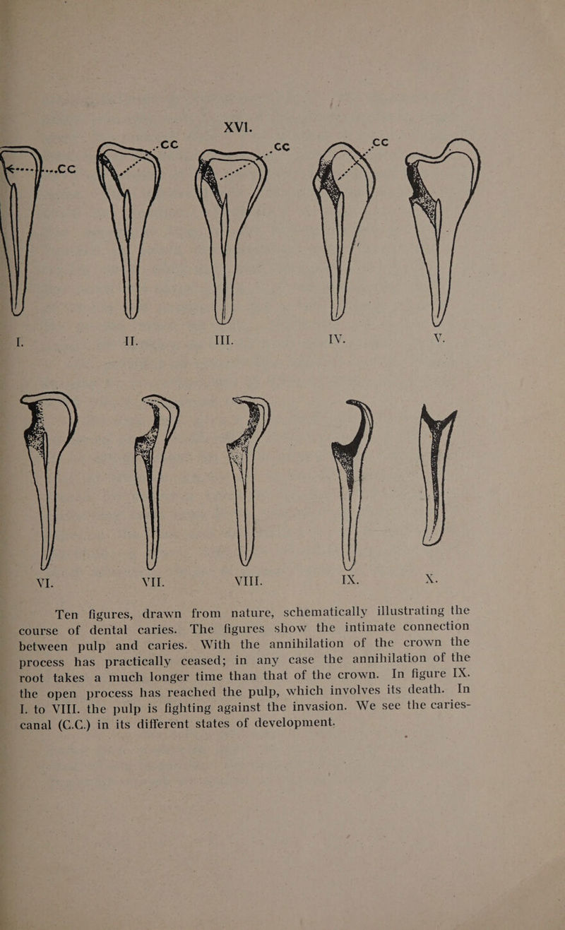 Ten figures, drawn from nature, schematically illustrating the course of dental caries. The figures show the intimate connection between pulp and caries. With the annihilation of the crown the process has practically ceased; in any case the annihilation of the root takes a much longer time than that of the crown. In figure IX. the open process has reached the pulp, which involves its death. In I. to VIII. the pulp is fighting against the invasion. We see the caries- canal (C.C.) in its different states of development.