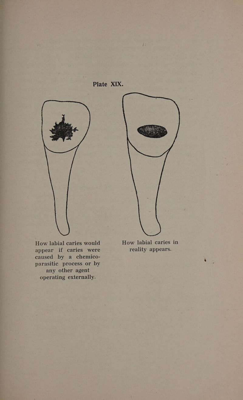 How labial caries would appear if caries were caused by a chemico- parasitic process or by any other agent operating externally.