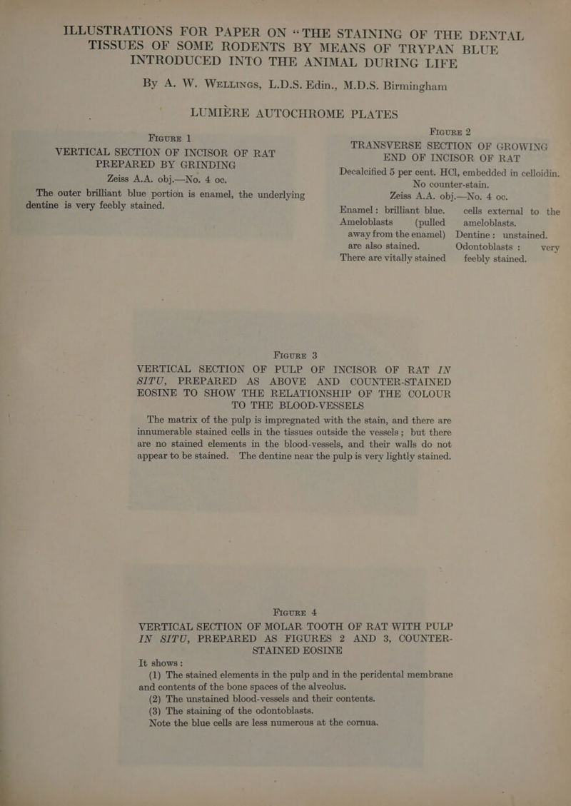 TISSUES OF SOME RODENTS BY MEANS OF TRYPAN BLUE INTRODUCED INTO THE ANIMAL DURING LIFE By A. W. WzrrumGs, L.D.S. Edin., M.D.S. Birmingham LUMIÈRE AUTOCHROME PLATES — FIGURE 2 TRANSVERSE SECTION OF GROWING VERTICAL SECTION OF INCISOR OF RAT END OF INCISOR OF RAT PREPARED BY GRINDING : Decalcified 5 per cent. HCl, embedded in celloidin. RO DU SUE. OU : No counter-stain. me, The outer brilliant blue portion is enamel, the underlying Zeiss A.A. obj.—No. 4 oc. dentine is very feebly stained. Enamel: brilliant blue. cells external to the Ameloblasts (pulled ameloblasts. away from the enamel) Dentine: unstained. are also stained. Odontoblasts : very There are vitally stained feebly stained. FIGURE 3 VERTICAL SECTION OF PULP OF INCISOR OF RAT IN SITU, PREPARED AS ABOVE AND COUNTER-STAINED EOSINE TO SHOW THE RELATIONSHIP OF THE COLOUR TO THE BLOOD-VESSELS The matrix of the pulp is impregnated with the stain, and there are innumerable stained cells in the tissues outside the vessels ; but there are no stained elements in the blood-vessels, and their walls do not appear to be stained. The dentine near the pulp is very lightly stained. FIGURE 4 VERTICAL SECTION OF MOLAR TOOTH OF RAT WITH PULP IN SITU, PREPARED AS FIGURES 2 AND 3, COUNTER- STAINED EOSINE It shows: (1) The stained elements in the pulp and in the peridental membrane and contents of the bone spaces of the alveolus. (2) The unstained blood-vessels and their contents. (3) The staining of the odontoblasts. Note the blue cells are less numerous at the cornua.