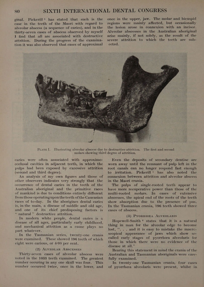 30 ginal. Pickerill! has stated that such is the case in the teeth of the Maori with regard to alveolar abscess (a sequence of caries), and in the thirty-seven cases of abscess observed by myself F find that all are associated with destructive attrition. During the progress of the examina- tion it was also observed that cases of approximal PLATE I. caries were often associated with approximo- occlusal cavities in adjacent teeth, in which the pulps had been exposed by excessive attrition (second and third degree). An analysis of my own figures and those of other observers indieates very strongly that the occurrence of dental caries in the teeth of the Australian aboriginal and the primitive races of mankind is due to conditions entirely different fromthoseoperatingupontheteeth ofthe Caucasian races of to-day. In the aborigines dental caries is, in the main, a disease of middle and old age, and one of its chief predisposing factors is “ natural  destructive attrition. In modern white people, dental caries is a disease of all ages, particularly early childhood, and mechanical attrition as a cause plays no part whatever. In the Tasmanian series, twenty-one crania were examined. These showed 196 teeth of which eight were carious, or 4°08 per cent. (2) ALVEOLAR ABSCESSES Thirty-seven cases of alveolar abscess were noted in the 1033 teeth examined. The greatest number occuring in any one skull was four. This number occurred twice, once in the lower, and once in the upper, jaw. The molar and bicuspid regions were mainly affected, but occasionally the lesion arose in connexion with an incisor. Alveolar abscesses in the Australian aboriginal arise mainly, if not solely, as the result of the severe attrition to which the teeth are sub- ected. The first and second Even the deposits of secondary dentine are worn away until the remnant of pulp left in the root canals can no longer respond fast enough to irritation. Pickerill ^ has also noted the connexion between attrition and alveolar abscess in the Maori crania. The pulps of single-rooted teeth appear to have more recuperative power than those of the multi-rooted molars. In cases of extensive abscesses, the apical end of the roots of the teeth show absorption due to the presence of pus. In the Tasmanian crania, 196 teeth showed three cases of abscess. (3) PYORRHŒA ALVEOLARIS Hopewell-Smith * states that it is a natural thing in man for the alveolar edge to become lost, **. . . and it is easy to mistake the macro- scopical appearance of jaws which show so- called early stages of pyorrhoea alveolaris tor those in which there were no evidence of the disease at all. : Bearing this statement in mind the crania of the Australian and Tasmanian aboriginals were care- fully examined. j In twenty-one Tasmanian crania, four cases of pyorrheea alveolaris were present, whilst in