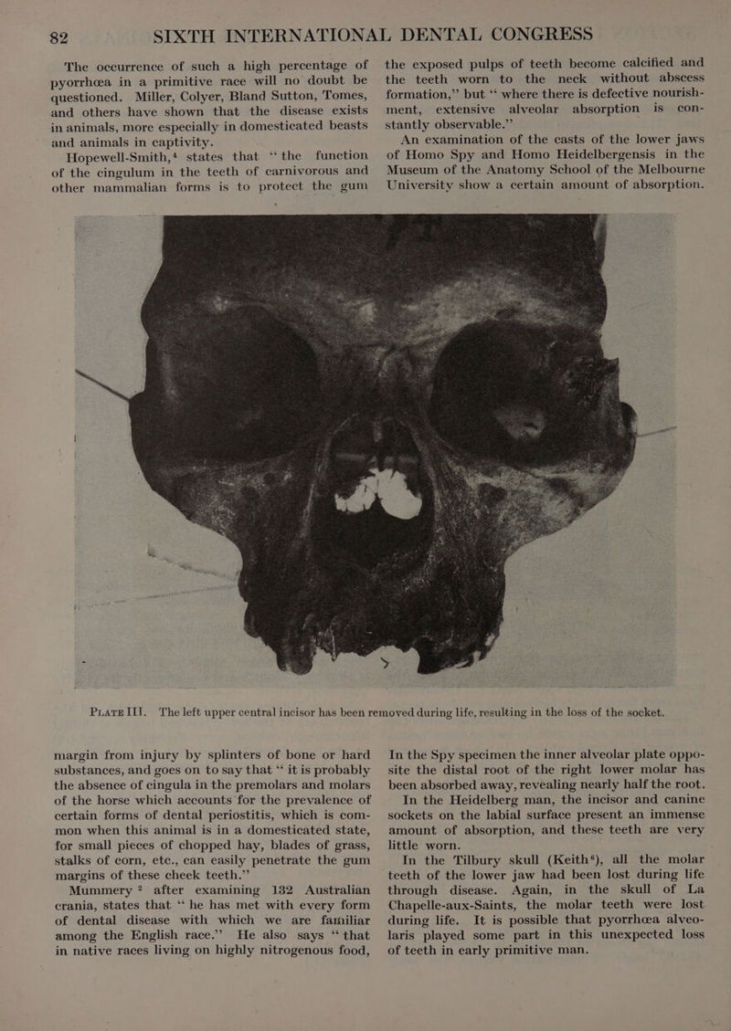 The occurrence of such a high percentage of pyorrhea in a primitive race will no doubt be questioned. Miller, Colyer, Bland Sutton, Tomes, and others have shown that the disease exists in animals, more especially in domesticated beasts and animals in captivity. Hopewell-Smith,* states that ‘the function of the cingulum in the teeth of carnivorous and other mammalian forms is to protect the gum the exposed pulps of teeth become calcified and the teeth worn to the neck without abscess formation, but ** where there is defective nourish- ment, extensive alveolar absorption is con- stantly observable.” | An examination of the casts of the lower jaws of Homo Spy and Homo Heidelbergensis in the Museum of the Anatomy School of the Melbourne University show a certain amount of absorption. PrATEIII. margin from injury by splinters of bone or hard substances, and goes on to say that “ it is probably the absence of cingula in the premolars and molars of the horse which accounts for the prevalence of certain forms of dental periostitis, which is com- mon when this animal is in a domesticated state, for small pieces of chopped hay, blades of grass, stalks of corn, etc., can easily penetrate the gum margins of these cheek teeth. Mummery ? after examining 132 Australian crania, states that ‘ he has met with every form of dental disease with which we are familiar among the English race. He also says ‘ that in native races living on highly nitrogenous food, In the Spy specimen the inner alveolar plate oppo- site the distal root of the right lower molar has been absorbed away, revealing nearly half the root. In the Heidelberg man, the incisor and canine sockets on the labial surface present an immense amount of absorption, and these teeth are very little worn. à In the Tilbury skull (Keith®), all the molar through disease. Again, in the skull of La Chapelle-aux-Saints, the molar teeth were lost during life. It is possible that pyorrhcea alveo- laris played some part in this unexpected loss of teeth in early primitive man.