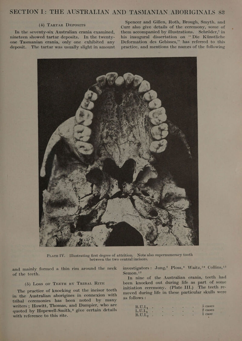 In the seventy-six Australian crania examined, nineteen showed tartar deposits. In the twenty- one Tasmanian crania, only one exhibited any deposit. The tartar was usually slight in amount Spencer and Gillen, Roth, Brough, Smyth, and Curr also give details of the ceremony, some of them accompanied by illustrations. Schröder,’ in his inaugural dissertation on *' Die Künstliche Deformation des Gebisses, has referred to this practice, and mentions the names of the following PLATE IV. and mainly formed a thin rim around the neck of the teeth. (5) Loss or TEETH BY TRIBAL RITE The practice of knocking out the incisor teeth in the Australian aborigines in connexion with tribal ceremonies has been noted by many writers ; Howitt, Thomas, and Dampier, who are quoted by Hopewell-Smith,* give certain details with reference to this rite. investigators: Jung,* Ploss,* Waitz,!® Collins,!! Semon. 1? In nine of the Australian crania, teeth had been knocked out during life as part of some initiation ceremony. (Plate III.) The teeth re- moved during life in these particular skulls were as follows : S ALES 5 cases L.U.I., 2 cases RUE l case to