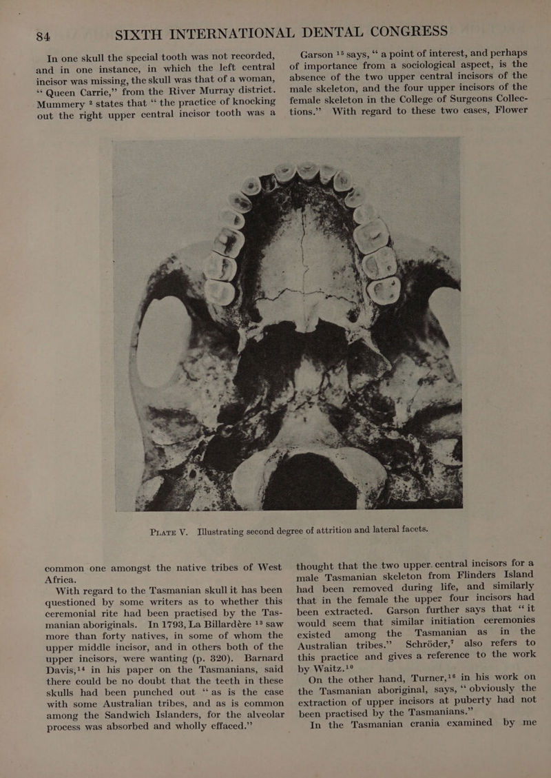 In one skull the special tooth was not recorded, and in one instance, in which the left central incisor was missing, the skull was that of a woman, ** Queen Carrie, from the River Murray district. Mummery ? states that ** the practice of knocking out the right upper central incisor tooth was a Garson 15 says, “ a point of interest, and perhaps of importance from a sociological aspect, is the absence of the two upper central incisors of the male skeleton, and the four upper incisors of the female skeleton in the College of Surgeons Collec- tions.’ With regard to these two cases, Flower common.one amongst the native tribes of West Africa. With regard to the Tasmanian skull it has been questioned by some writers as to whether this ceremonial rite had been practised by the Tas- manian aboriginals. In 1793,La Billardére !? saw more than forty natives, in some of whom the upper middle incisor, and in others both of the upper incisors, were wanting (p. 320). Barnard Davis,!* in his paper on the Tasmanians, said there could be no doubt that the teeth in these skulls had been punched out ‘as is the case with some Australian tribes, and as is common among the Sandwich Islanders, for the alveolar process was absorbed and wholly effaced. thought that the two upper. central incisors for a male Tasmanian skeleton from Flinders Island had been removed during life, and similarly that in the female the upper four incisors had been extracted. Garson further says that “it would seem that similar initiation ceremonies existed among the Tasmanian as in the Australian tribes. Schröder,” also refers to this practice and gives a reference to the work by Waitz.!? On the other hand, Turner,!? in his work on the Tasmanian aboriginal, says, * obviously the extraction of upper incisors at puberty had not been practised by the Tasmanians.” In the Tasmanian crania examined by me