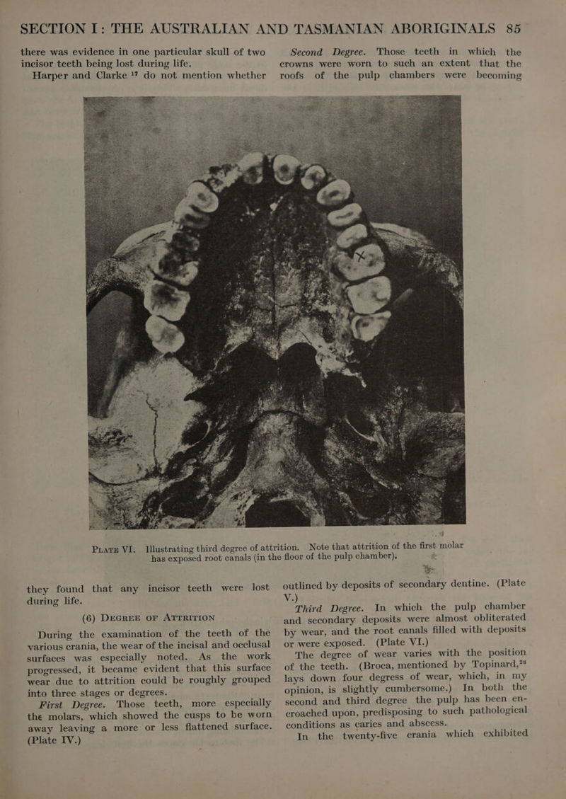 incisor teeth being lost during life. Harper and Clarke 1? do not mention whether crowns were worn to such an extent that the roofs of the pulp chambers were becoming PLATE VI. they found that any incisor teeth were lost during life. (6) DEGREE OF ATTRITION During the examination of the teeth of the various crania, the wear of the incisal and occlusal surfaces was especially noted. As the work progressed, it became evident that this surface wear due to attrition could be roughly grouped into three stages or degrees. First Degree. Those teeth, more especially the molars, which showed the cusps to be worn away leaving a more or less flattened surface. (Plate IV.) X outlined by deposits of secondary dentine. (Plate V.) Third Degree. In which the pulp chamber and secondary deposits were almost obliterated by wear, and the root canals filled with deposits or were exposed. (Plate VI.) The degree of wear varies with the position of the teeth. (Broca, mentioned by Topinard,** lays down four degress of wear, which, in my opinion, is slightly cumbersome.) In both the second and third degree the pulp has been en- croached upon, predisposing to such pathological conditions as caries and abscess. In the twenty-five crania which exhibited