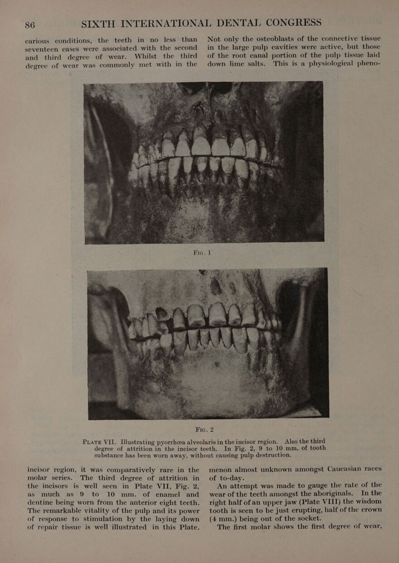 seventeen cases were associated with the second and third degree of wear. Whilst the third degree of wear was commonly met with in the This is a physiological pheno- Also the third incisor region, it was comparatively rare in the molar series. The third degree of attrition in the incisors is well seen in Plate VII, Fig. 2, as much as 9 to 10 mm. of enamel and dentine being worn from the anterior eight teeth. 'The remarkable vitality of the pulp and its power of response to stimulation by the laying down of repair tissue is well illustrated in this Plate. menon almost unknown amongst Caucasian races of to-day. An attempt was made to gauge the rate of the wear of the teeth amongst the aboriginals. In the right half of an upper jaw (Plate VIII) the wisdom tooth is seen to be just erupting, half of the crown (4 mm.) being out of the socket. The first molar shows the first degree of wear,