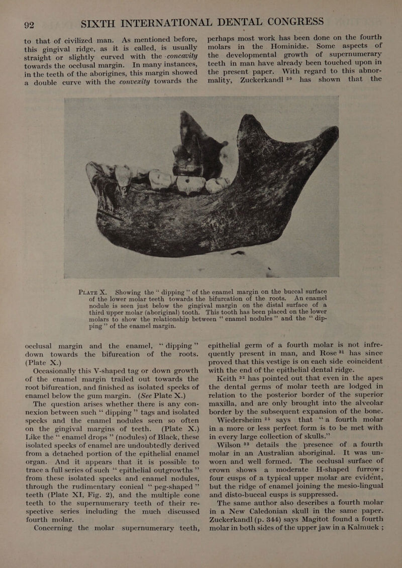 to that of eivilized man. As mentioned before, this gingival ridge, as it is called, is usually straight or slightly curved with the -concavity towards the occlusal margin. In many instances, in the teeth of the aborigines, this margin showed a double curve with the convewity towards the perhaps most work has been done on the fourth molars in the. Hominidæ. Some aspects of the developmental growth of supernumerary With regard to this abnor- Zuckerkandl an has shown that the PLATE X. An enamel ping  of the enamel margin. occlusal margin and the enamel, “ dipping ” down towards the bifurcation of the roots. (Plate X.) Occasionally this V-shaped tag or down growth of the enamel margin trailed out towards the root bifurcation, and finished as isolated specks of enamel below the gum margin. (See Plate X.) The question arises whether there is any con- nexion between such ** dipping  tags and isolated specks and the enamel nodules seen so often on the gingival margins of teeth. (Plate X.) Like the ** enamel drops  (nodules) of Black, these isolated specks of enamel are undoubtedly derived from a detached portion of the epithelial enamel organ. And it appears that it is possible to trace a full series of such ** epithelial outgrowths ”’ from these isolated specks and enamel nodules, through the rudimentary conical ‘“ peg-shaped ” teeth (Plate XI, Fig. 2), and the multiple cone teeth to the supernumerary teeth of their re- spective series including the much discussed fourth molar. Concerning the molar supernumerary teeth, epithelial germ of a fourth molar is not infre- quently present in man, and Rose?! has since proved that this vestige is on each side coincident with the end of the epithelial dental ridge. ; Keith ?? has pointed out that even in the apes the dental germs of molar teeth are lodged in relation to the posterior border of the superior maxilla, and are only brought into the alveolar border by the subsequent expansion of the bone. Wiedersheim 25 says that “a fourth molar in a more or less perfect form is to be met with in every large collection of skulls.” Wilson 3® details the presence of a fourth molar in an Australian aboriginal. It was un- worn and well formed. The occlusal surface of crown shows a moderate H-shaped furrow; four cusps of a typical upper molar are evident, but the ridge of enamel joining the mesio-lingual and disto-buccal cusps is suppressed. The same author also describes a fourth molar in a New Caledonian skull in the same paper. Zuckerkandl (p. 344) says Magitot found a fourth molar in both sides of the upper jaw in a Kalmuck ;