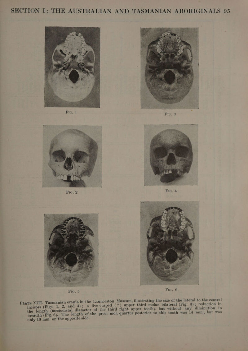 Bie.) Fra. 4 Fic. 5 PLATE XIII. Tasmanian crania in the Launceston Museum, illustrating the size of the lateral to the central incisors (Figs. 1, 2, and 4); a five-cusped (?) upper third molar bilateral (Fig. 3); reduction in the length (mesiodistal diameter of the third right upper tooth)’ but without any diminution in breadth (Fig. 6). The length of the proc. mol. quartus posterior to this tooth was 14 mm., but was only 10 mm. on the opposite side.