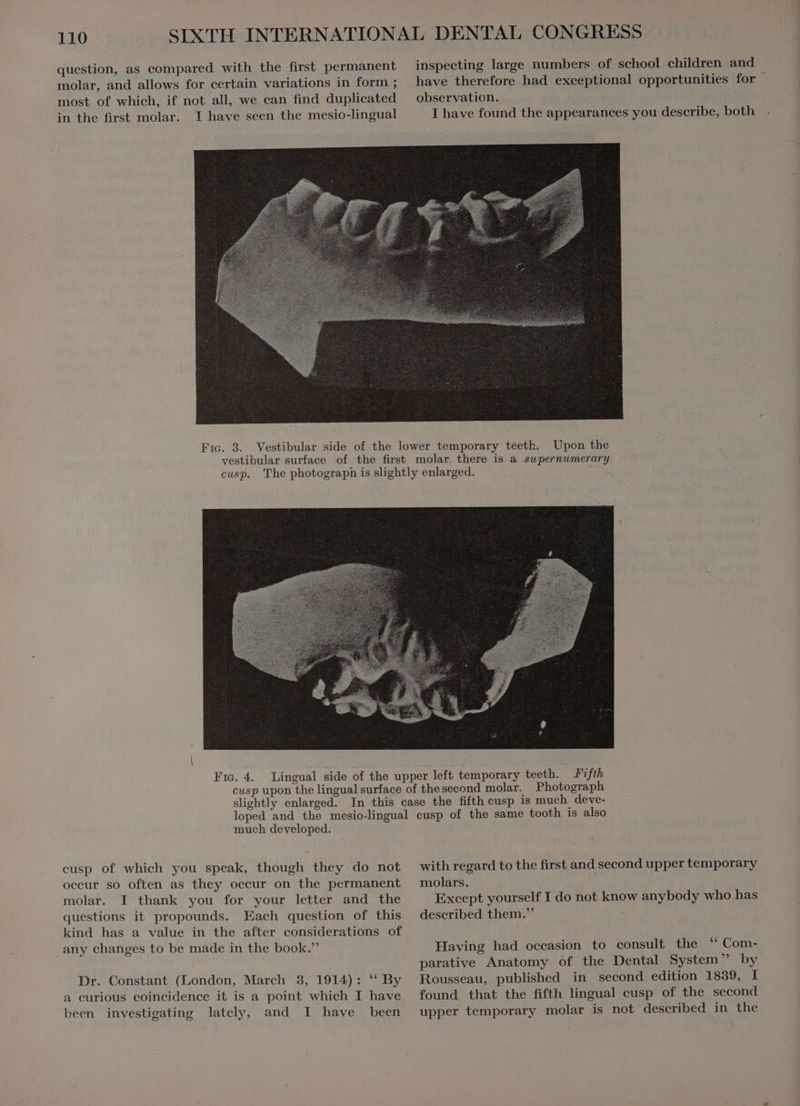 in the first molar. inspecting large numbers of school children and have therefore had exceptional opportunities for ` observation. I have found the appearances you describe, both Niels 34- Upon the Fic. 4. eusp of which you speak, though they do not occur so often as they occur on the permanent molar. I thank you for your letter and the questions it propounds. Each question of this kind has a value in the after considerations of any changes to be made in the book. Dr. Constant (London, March 3, 1914): “ By a curious coincidence it is a point which I have been investigating lately, and I have been with regard to the first and second upper temporary molars. Except yourself I do not know anybody who has described them. Having had occasion to consult the Com: parative Anatomy of the Dental System by Rousseau, published in second edition 1839, I found that the fifth lingual cusp of the second upper temporary molar is not deseribed in the