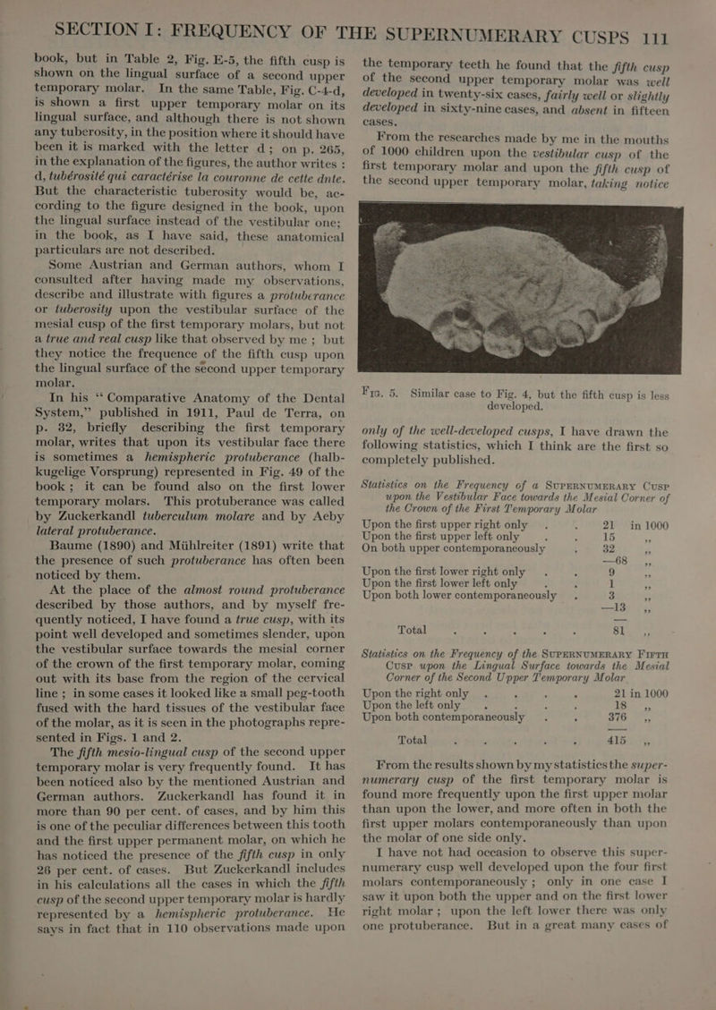 shown on the lingual surface of a second upper temporary molar. In the same Table, Fig. C-4-d, is shown a first upper temporary molar on its lingual surface, and although there is not shown any tuberosity, in the position where it should have been it is marked with the letter d; on p. 265, in the explanation of the figures, the author writes : d, tubérosité qui caractérise la couronne de cette dnte. But the characteristic tuberosity would be, ac- cording to the figure designed in the book, upon the lingual surface instead of the vestibular one; in the book, as I have said, these anatomical partieulars are not described. Some Austrian and German authors, whom I consulted after having made my observations, describe and illustrate with figures a protuberance or fuberosity upon the vestibular surface of the mesial cusp of the first temporary molars, but not a true and real cusp like that observed by me ; but they notice the frequence of the fifth cusp upon the lingual surface of the second upper temporary molar. In his * Comparative Anatomy of the Dental System, published in 1911, Paul de Terra, on p. 32, briefly describing the first temporary molar, writes that upon its vestibular face there is sometimes a hemispheric protuberance (halb- kugelige Vorsprung) represented in Fig. 49 of the book; it can be found also on the first lower temporary molars. This protuberance was called ‚by Zuckerkandl tuberculum molare and by Aeby lateral protuberance. Baume (1890) and Mühlreiter (1891) write that the presence of such protuberance has often been noticed by them. At the place of the almost round protuberance described by those authors, and by myself fre- quently noticed, I have found a true cusp, with its point well developed and sometimes slender, upon the vestibular surface towards the mesial corner of the crown of the first temporary molar, coming out with its base from the region of the cervical line ; in some cases it looked like a small peg-tooth fused with the hard tissues of the vestibular face of the molar, as it is seen in the photographs repre- sented in Figs. 1 and 2. The fifth mesio-lingual cusp of the second upper temporary molar is very frequently found. It has been noticed also by the mentioned Austrian and German authors. Zuckerkandl has found it in more than 90 per cent. of cases, and by him this is one of the peculiar differences between this tooth and the first upper permanent molar, on which he has noticed the presence of the fifth cusp in only 26 per cent. of cases. But Zuckerkandl includes in his calculations all the cases in which the fifth cusp of the second upper temporary molar is hardly represented by a hemispheric protuberance. He says in fact that in 110 observations made upon the temporary teeth he found that the fifth cusp of the second upper temporary molar was well developed in twenty-six cases, fairly well or slightly developed in sixty-nine cases, and absent in fifteen cases. From the researches made by me in the mouths of 1000. children upon the vestibular cusp of the first temporary molar and upon the fifth cusp of the second upper temporary molar, taking notice Fra. 5. Similar case to Fig. 4, but the fifth cusp is less developed. only of the well-developed cusps, I have drawn the following statistics, which I think are the first so completely published. Statistics on the Frequency of a SUPERNUMERARY CusP upon the Vestibular Face towards the Mesial Corner of the Crown of the First Temporary Molar Upon the first upper right only . : 21 in 1000 Upon the first upper left only : e 15 On both upper contemporaneously 1 32 D —68 29 Upon the first lower right only : 9 £ Upon the first lower left only J é 1 Upon both lower contemporaneously 3 5 13 ” Total : e : : : 81 LÉI Statistics on the Frequency of the SUPERNUMERARY FETH Cusp upon the Lingual Surface towards the Mesial Corner of the Second Upper Temporary Molar Upon the right only e À 21 in 1000 Upon the left only : : : 18 Upon both contemporaneously Total From the results shown by my statistics the super- numerary cusp of the first temporary molar is found more frequently upon the first upper molar than upon the lower, and more often in both the first upper molars contemporaneously than upon the molar of one side only. I have not had occasion to observe this super- numerary cusp well developed upon the four first molars contemporaneously ; only in one case I saw it upon both the upper and on the first lower right molar; upon the left lower there was only one protuberance. But in a great many cases of