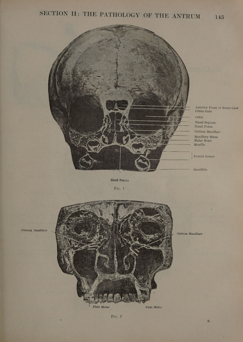 Anterior Fossa of Brain-Case Crista Gain Orbit Nasal Septum Nasal Fossa Ostium Maxillare Maxillary Sinus Malar Bone Maxilla f Dental Germs ———— Mandible | | Hard Palate RTE 1% Ostium Maxillare Ostium Maxillare Fra. 2 m