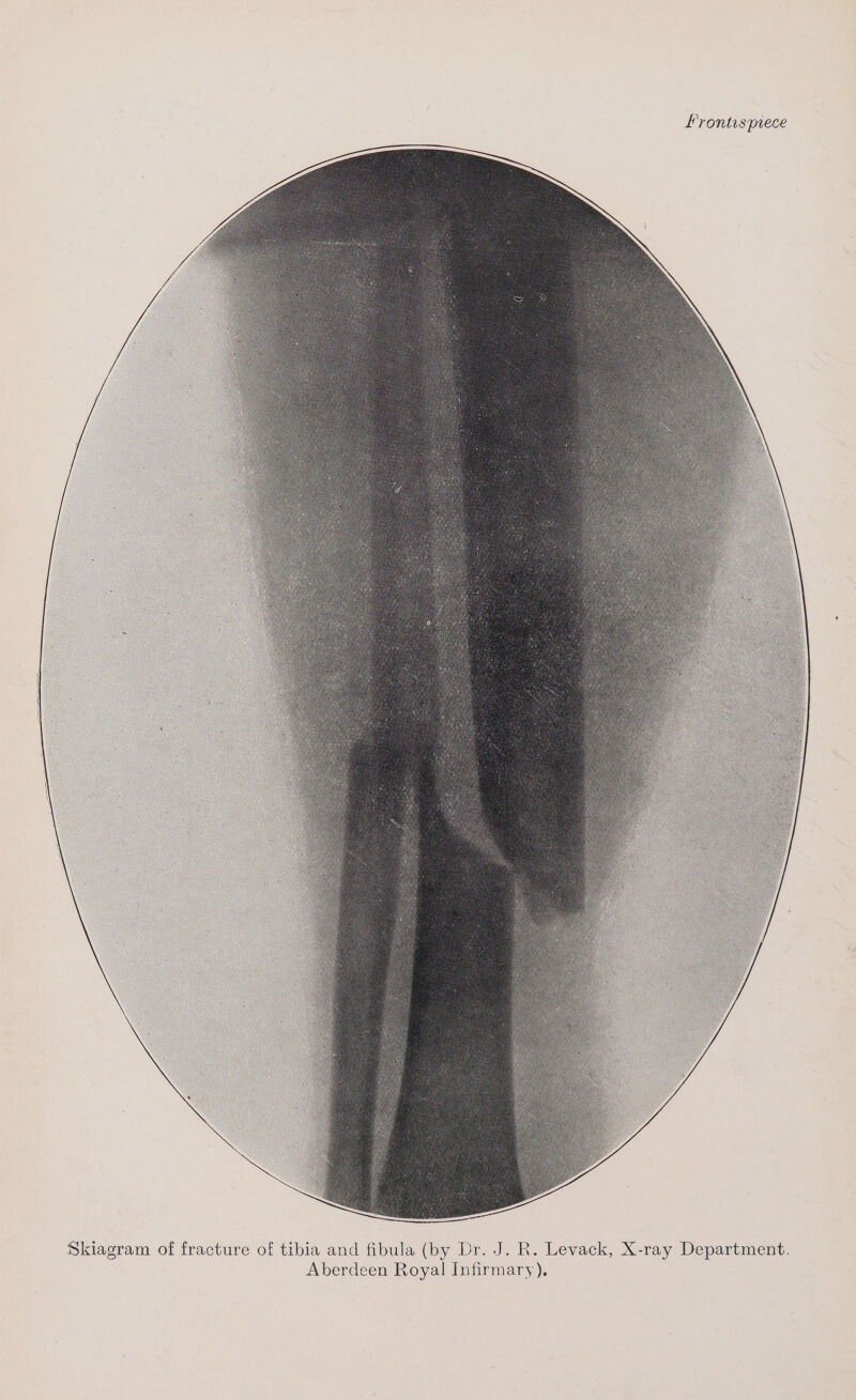 frontispiece J. R. Levack, X-ray Department. IDR. Aberdeen Royal Infirmary), (by Skiagram of fracture of tibia and fibula