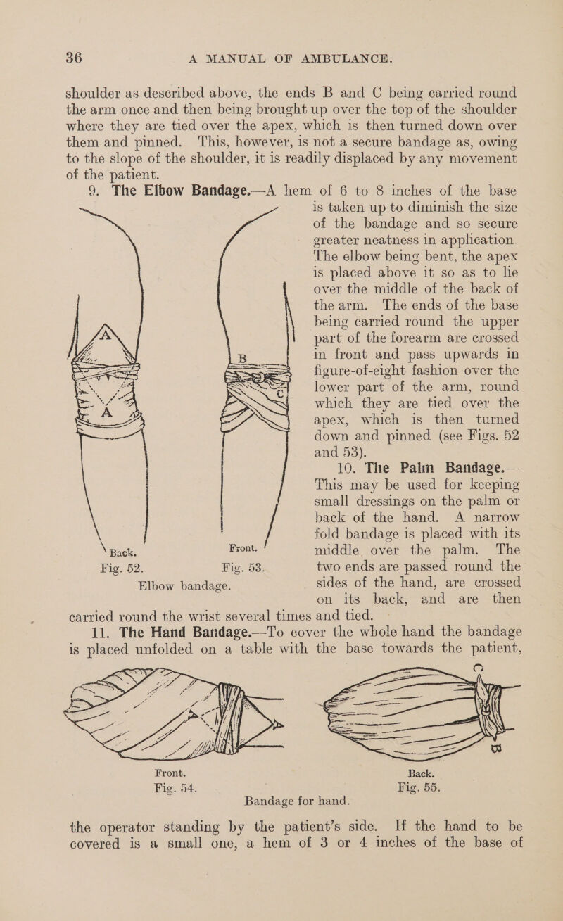 shoulder as described above, the ends B and C being carried round the arm once and then being brought up over the top of the shoulder where they are tied over the apex, which is then turned down over them and pinned. ‘This, however, is not a secure bandage as, owing to the slope of the shoulder, it 1s readily displaced by any movement of the patient. 9, The Elbow Bandage.—A hem of 6 to 8 inches of the base ~ is taken up to diminish the size of the bandage and so secure greater neatness in application. The elbow being bent, the apex is placed above it so as to he over the middle of the back of the arm. The ends of the base being carried round the upper part of the forearm are crossed in front and pass upwards in figure-of-eight fashion over the lower part of the arm, round which they are tied over the apex, which is then turned down and pinned (see Figs. 52 and 53). 10. The Palm Bandage.—. This may be used for keeping small dressings on the palm or back of the hand. A narrow fold bandage is placed with its ront. / \ Back. middle. over the palm. The Fig. 52. Fig. 53. two ends are passed round the Elbow bandage. sides of the hand, are crossed on its back, and are then carried round the wrist several times and tied. — 11. The Hand Bandage.—-To cover the whole hand the bandage is placed unfolded on a table with the base towards the patient, Q Front. Back. Fig. 54. Fig. 55. Bandage for hand. the operator standing by the patient’s side. If the hand to be covered is a small one, a hem of 3 or 4 inches of the base of