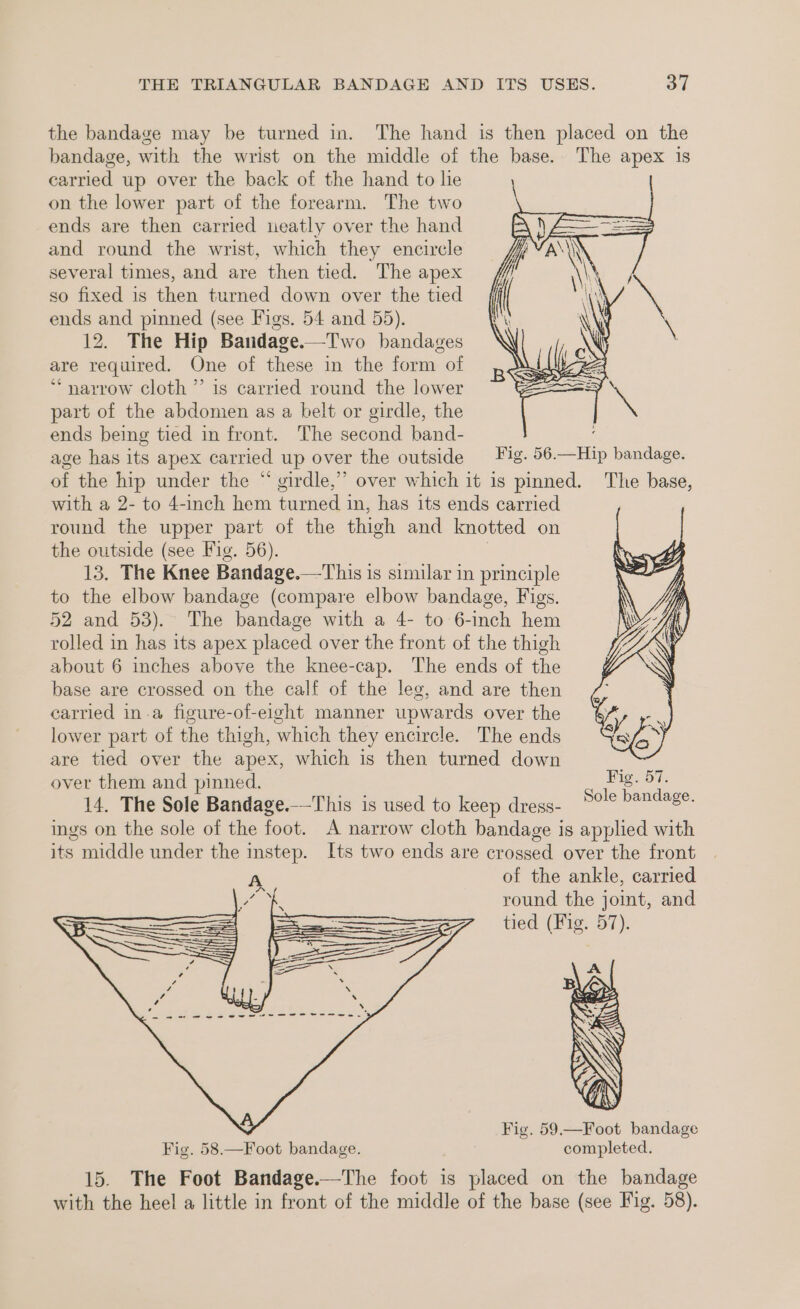 bandage, with the wrist on the middle of the base. carried up over the back of the hand to lie on the lower part of the forearm. The two ends are then carried neatly over the hand and round the wrist, which they encircle several times, and are then tied. The apex so fixed is then turned down over the tied ends and pinned (see Figs. 54 and 55). 12. The Hip Bandage.—Two bandages are required. One of these in the form of “narrow cloth” is carried round the lower part of the abdomen as a belt or girdle, the ends being tied in front. The second band- The apex is with a 2- to 4-inch hem turned in, has its ends carried round the upper part of the thigh and knotted on the outside (see Fig. 56). 13, The Knee Bandage.—This is similar in principle to the elbow bandage (compare elbow bandage, Figs. 52 and 53). The bandage with a 4- to 6-inch hem rolled in has its apex placed over the front of the thigh about 6 inches above the knee-cap. The ends of the base are crossed on the calf of the leg, and are then carried in-a figure-of-eight manner upwards over the lower part of the thigh, which they encircle. The ends are tied over the apex, which is then turned down ovet them and pinned. 14. The Sole Bandage.-—-This is used to keep dress- g Sole bandage. its middle under the instep. Its two ends are crossed over the front x of the ankle, carried ae round the jot, and oH ———— ee tied (Fig. BT): 15. The Foot Bandage.—The foot is placed on completed. the bandage