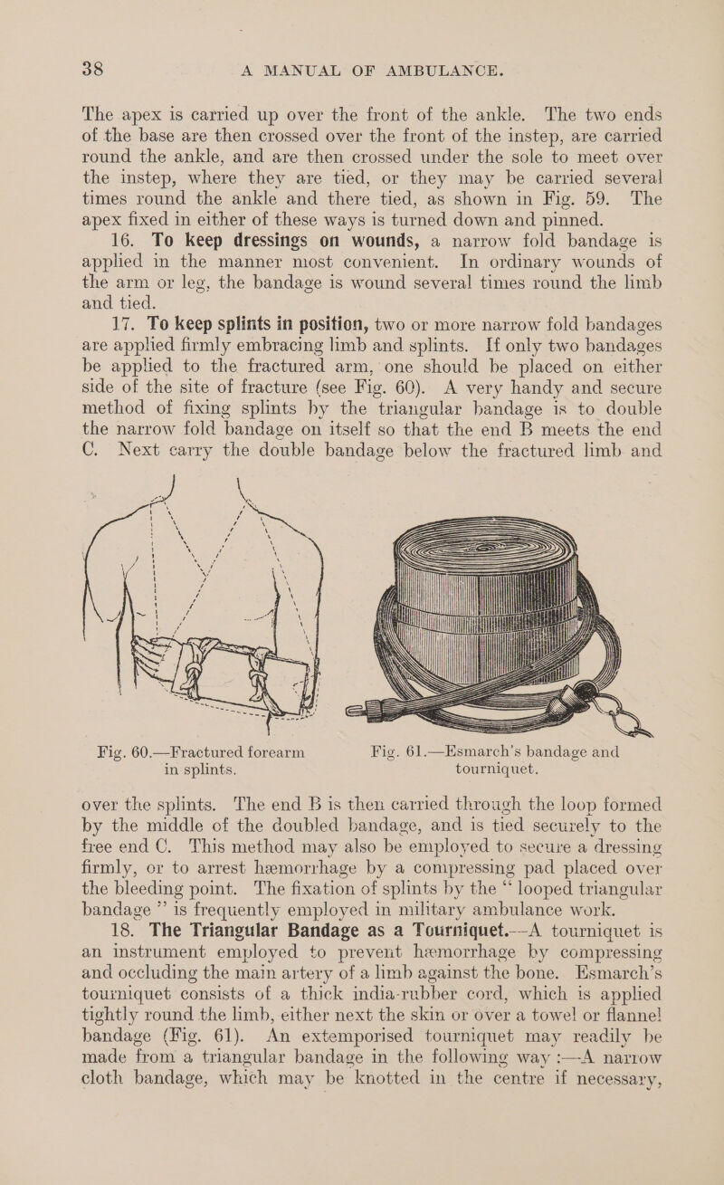 The apex is carried up over the front of the ankle. The two ends of the base are then crossed over the front of the instep, are carried round the ankle, and are then crossed under the sole to meet over the instep, where they are tied, or they may be carried several times round the ankle and there tied, as shown in Fig. 59. The apex fixed in either of these ways is turned down and pinned. 16. To keep dressings on wounds, a narrow fold bandage is applied in the manner most convenient. In ordinary wounds of the arm or leg, the bandage is wound several times round the limb and tied. 17. To keep splits in position, two or more narrow fold bandages are applied firmly embracing limb and splints. H only two bandages be applied to the fractured arm, one should be placed on either side of the site of fracture (see Fig. 60). A very handy and secure method of fixing splints by the triangular bandage is to double the narrow fold bandage on itself so that the end B meets the end C. Next carry the double bandage below the fractured limb and over the splints. The end B is then carried through the loop formed by the middle of the doubled bandage, and is tied securely to the free end C. This method may also be employed to secure a dressing firmly, or to arrest hemorrhage by a compressing pad placed over the bleeding point. The fixation of splints by the “ looped triangular bandage ” is frequently employed in military ambulance work. 18. The Triangular Bandage as a Tourniquet.-A tourniquet is an instrument employed to prevent hemorrhage by compressing and occluding the maim artery of a imb against the bone. Esmarch’s tourniquet consists of a thick india-rubber cord, which 1s applied tightly round the limb, either next the skin or over a towel or flannel! bandage (Fig. 61). An extemporised tourniquet may readily be made from a triangular bandage in the followmg way :—-A narrow cloth bandage, which may be knotted in the centre if necessary,