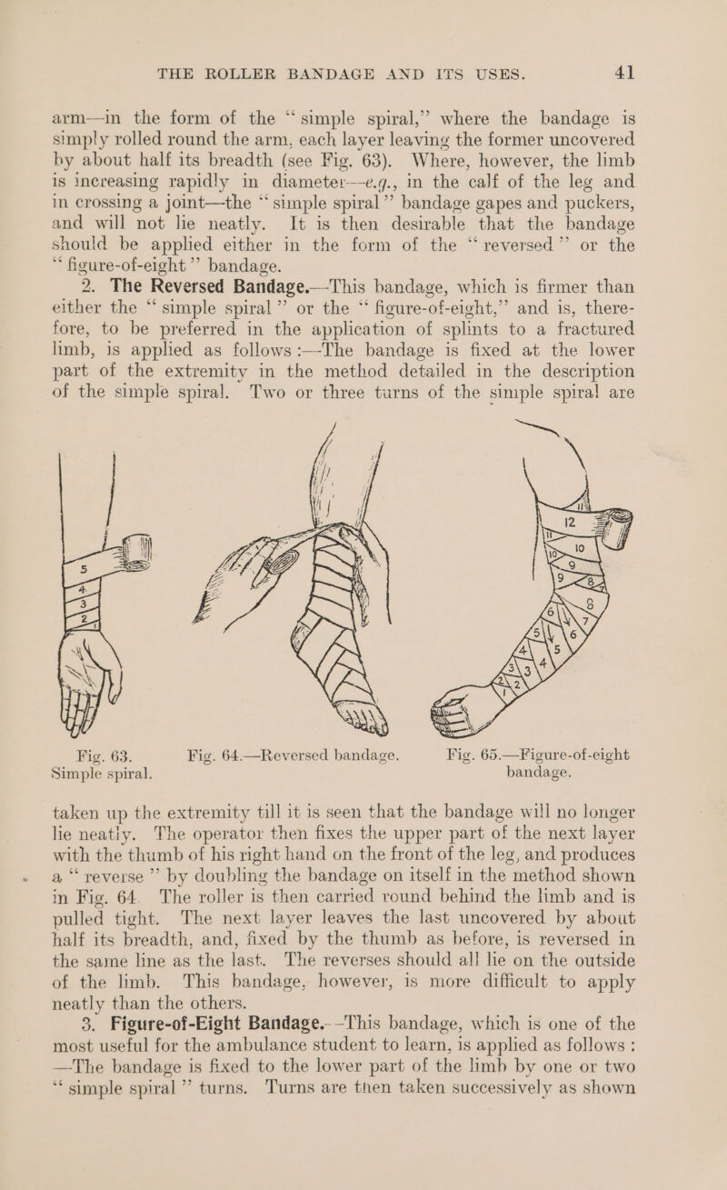 ¢ arm—in the form of the “simple spiral,’ where the bandage is simply rolled round the arm, each layer leaving the former uncovered by about half its breadth (see Fig. 63). Where, however, the limb is Increasing rapidly in diameter---e.y., in the calf of the leg and in crossing a joint—the “simple spiral”’ bandage gapes and puckers, and will not le neatly. It is then desirable that the bandage should be applied either in the form of the “reversed”’ or the * figure-of-eight ”’ bandage. 2. The Reversed Bandage._-This bandage, which is firmer than either the “simple spiral” or the “ figure-of-eight,” and is, there- fore, to be preferred in the application of splmts to a fractured limb, is apphed as follows :—-The bandage is fixed at the lower part of the extremity in the method detailed in the description of the simple spiral. Two or three turns of the simple spiral are taken up the extremity till it is seen that the bandage will no longer lie neatiy. The operator then fixes the upper part of the next layer with the thumb of his right hand on the front of the leg, and produces a “reverse ”’ by doubling the bandage on itself in the method shown in Fig. 64. The roller is then carried round behind the limb and is pulled tight. The next layer leaves the last uncovered by about half its breadth, and, fixed by the thumb as before, is reversed in the same line as the last. The reverses should all he on the outside of the limb. This bandage, however, is more difficult to apply neatly than the others. 3. Figure-of-Eight Bandage.-—This bandage, which is one of the most useful for the ambulance student to learn, is applied as follows : —The bandage is fixed to the lower part of the limb by one or two ‘simple spiral’ turns. Turns are then taken successively as shown