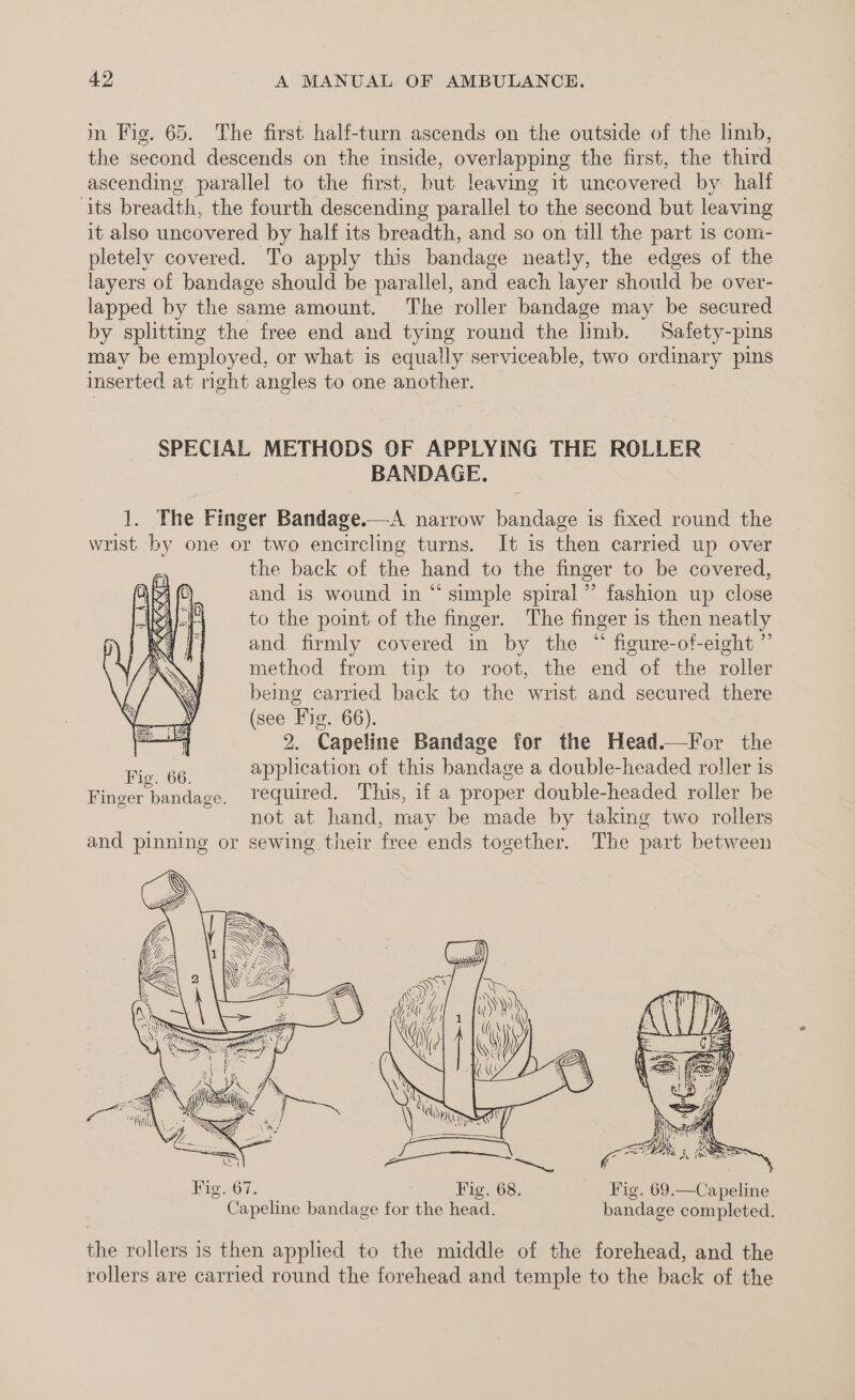 in Fig. 65. The first half-turn ascends on the outside of the limb, the second descends on the inside, overlapping the first, the third ascending parallel to the first, but leaving it uncovered by half ‘its breadth, the fourth descending parallel to the second but leaving it also uncovered by half its breadth, and so on till the part is com- pletely covered. To apply this bandage neatly, the edges of the layers of bandage should be parallel, and each layer should be over- lapped by the same amount. The roller bandage may be secured by splitting the free end and tying round the limb. Safety-pins may be employed, or what is equally serviceable, two ordinary pins inserted at right angles to one another. oo METHODS OF APPLYING THE ROLLER BANDAGE. 1. The Finger Bandage.—-A narrow bandage is fixed round the wrist by one or two encircling turns. It is then carried up over the back of the hand to the finger to be covered, and is wound in “simple spiral” fashion up close to the point of the finger. The finger 1 is then neatly and firmly covered in by the “ figure-of-eight ” method from tip to root, the end of the roller being ae back to the wrist and secured there (see Fig. 66). 2. Capeline Bandage for the Head.—For the Fig. 66. application of this bandage a double-headed roller is Finger bandage, Tequired. This, if a proper double-headed roller be not at hand, may be made by taking two rollers and pinning or sewing their free ends together. The part between the rollers is then applied to the middle of the forehead, and the rollers are carried round the forehead and temple to the back of the